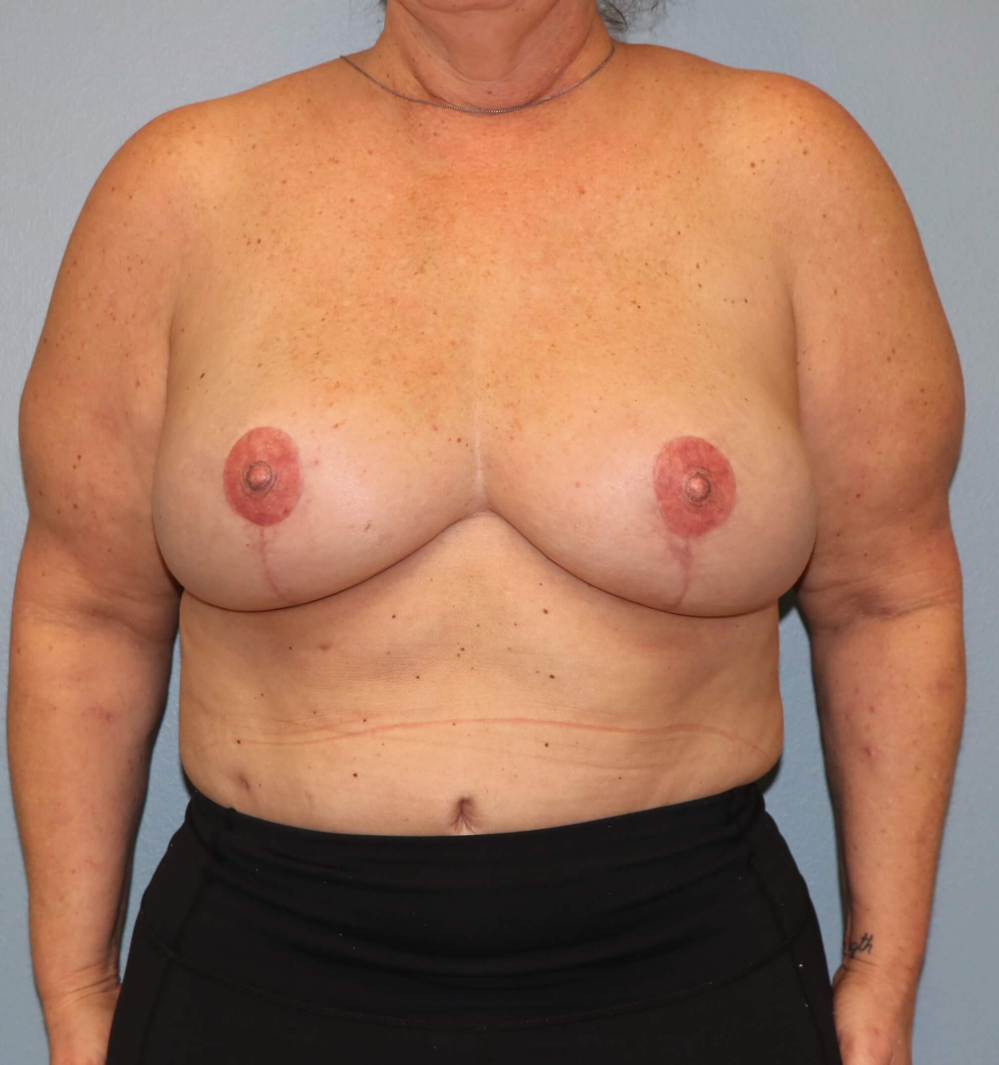 DIEP Flaps with ReSensation After Bilateral DIEP Flaps
