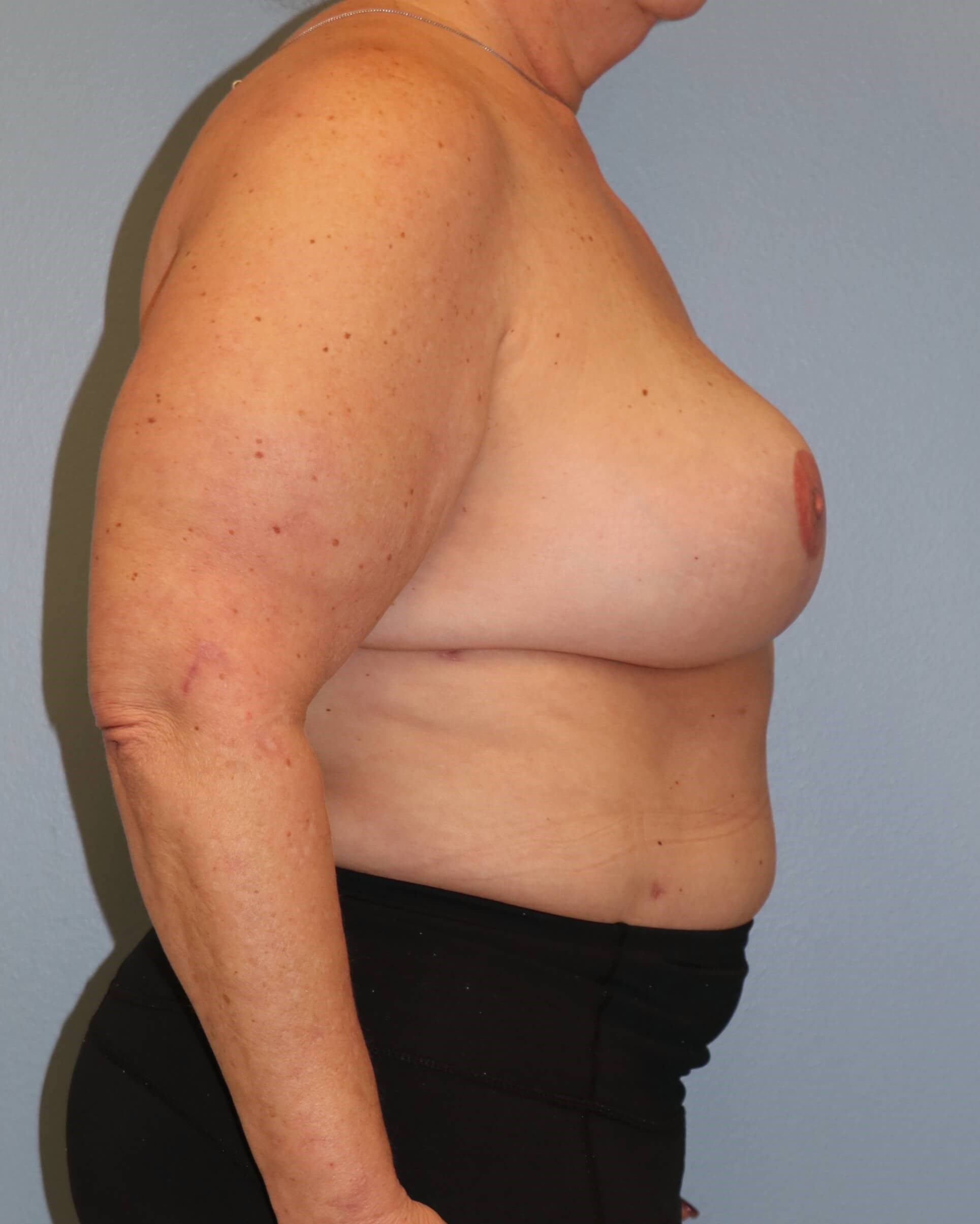 DIEP Flaps with ReSensation After Bilateral DIEP Flaps