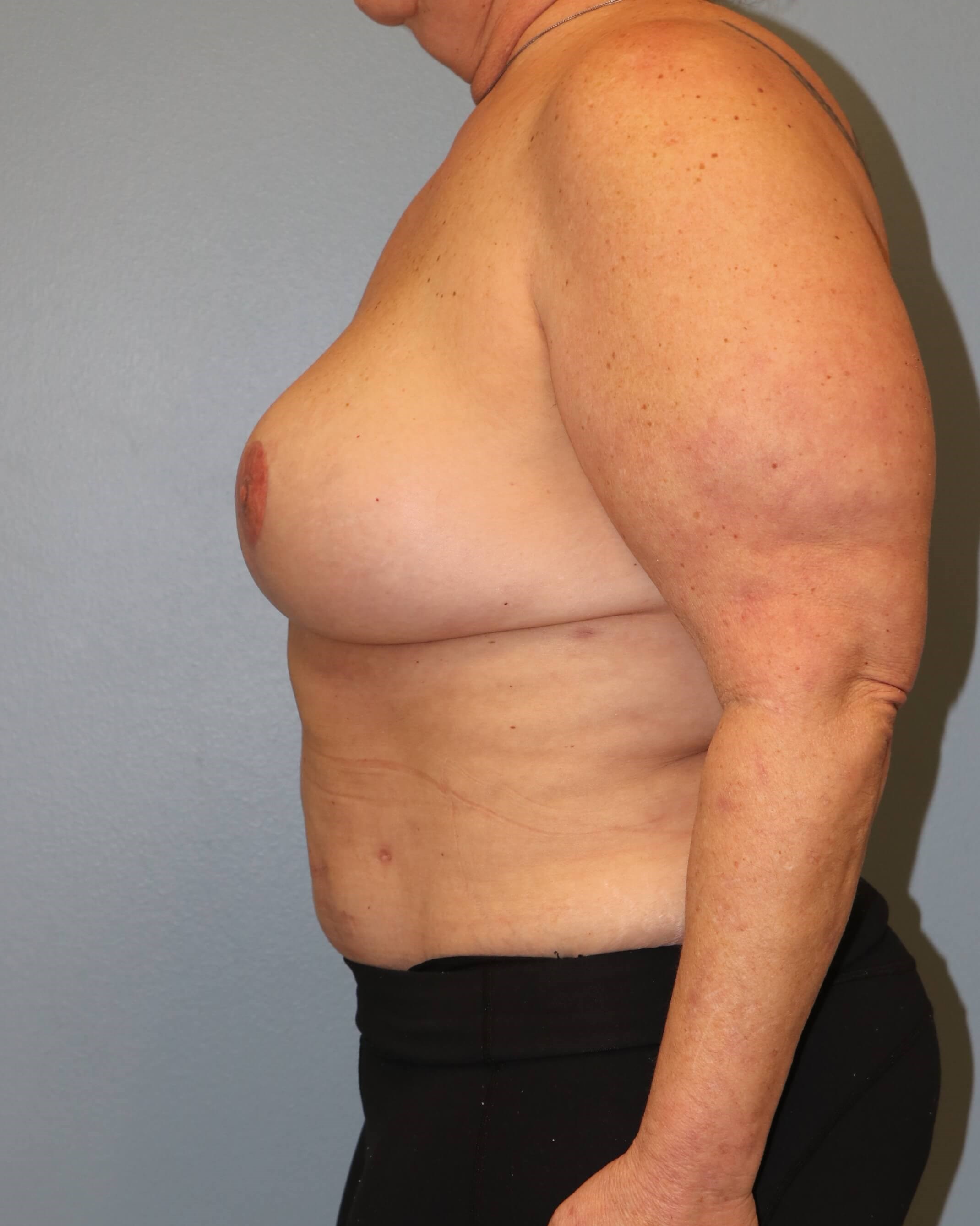 DIEP Flaps with ReSensation After Bilateral DIEP Flaps