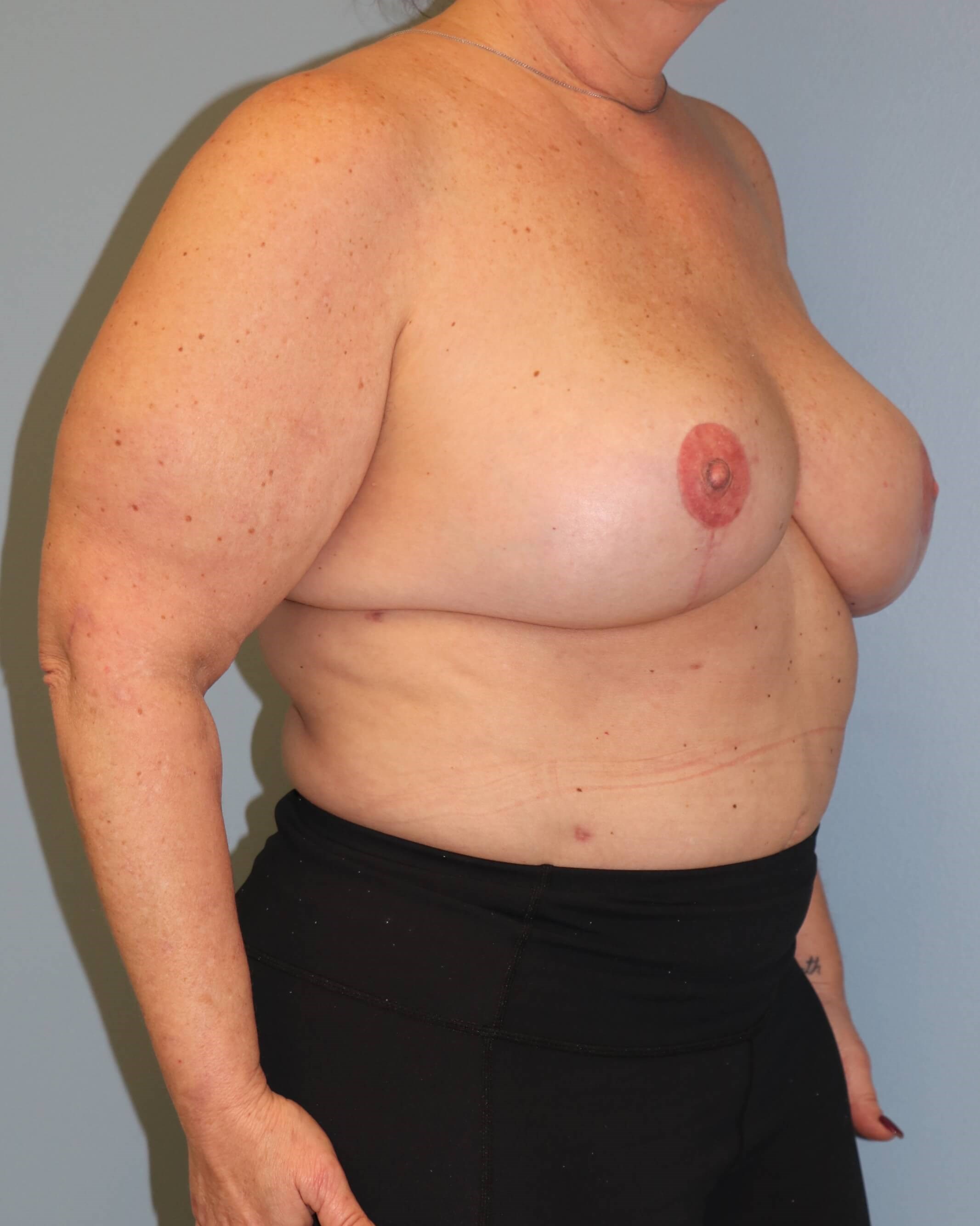 DIEP Flaps with ReSensation After Bilateral DIEP Flaps