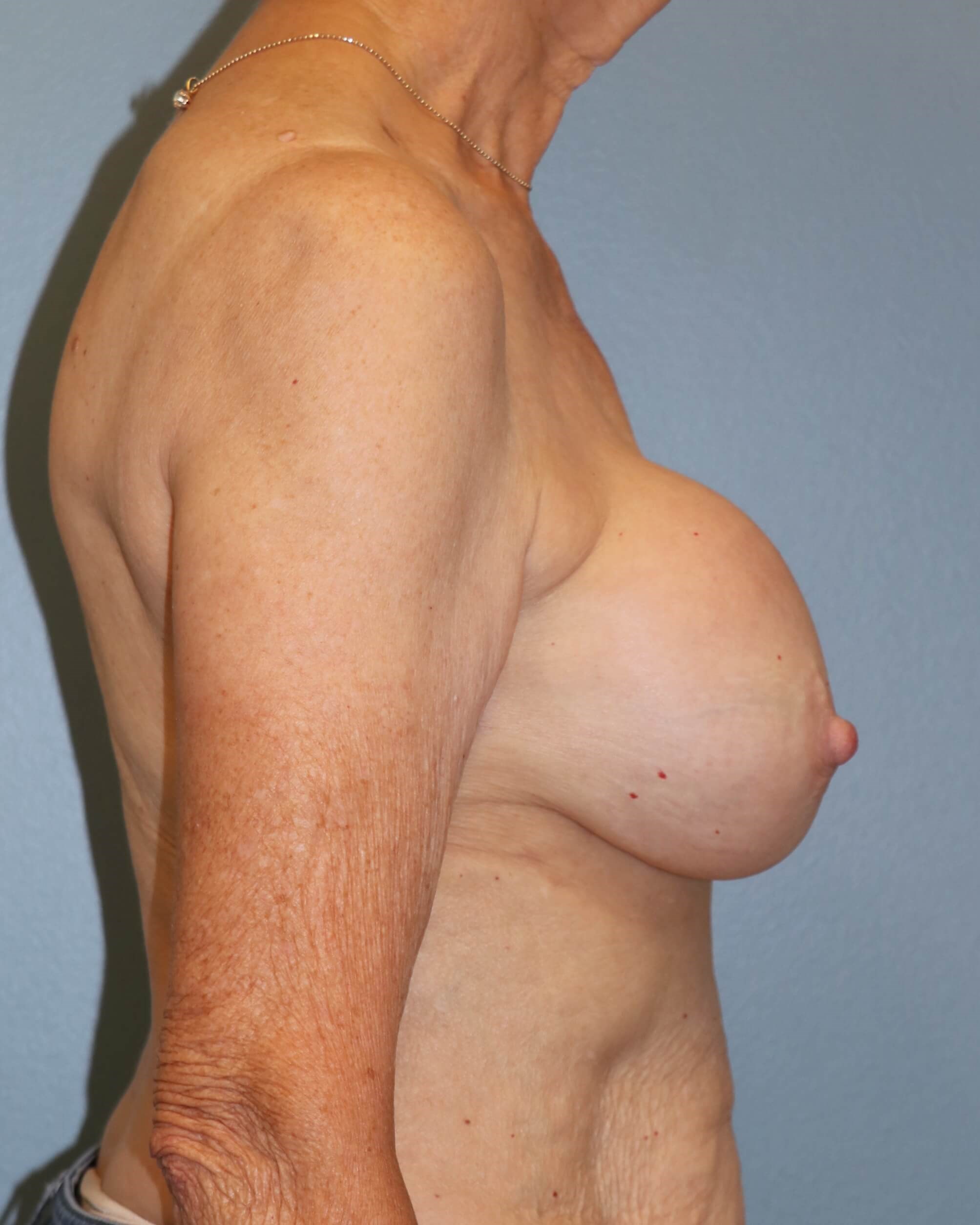 Capsulectomy, Implant Exchange Before Implant Replacement