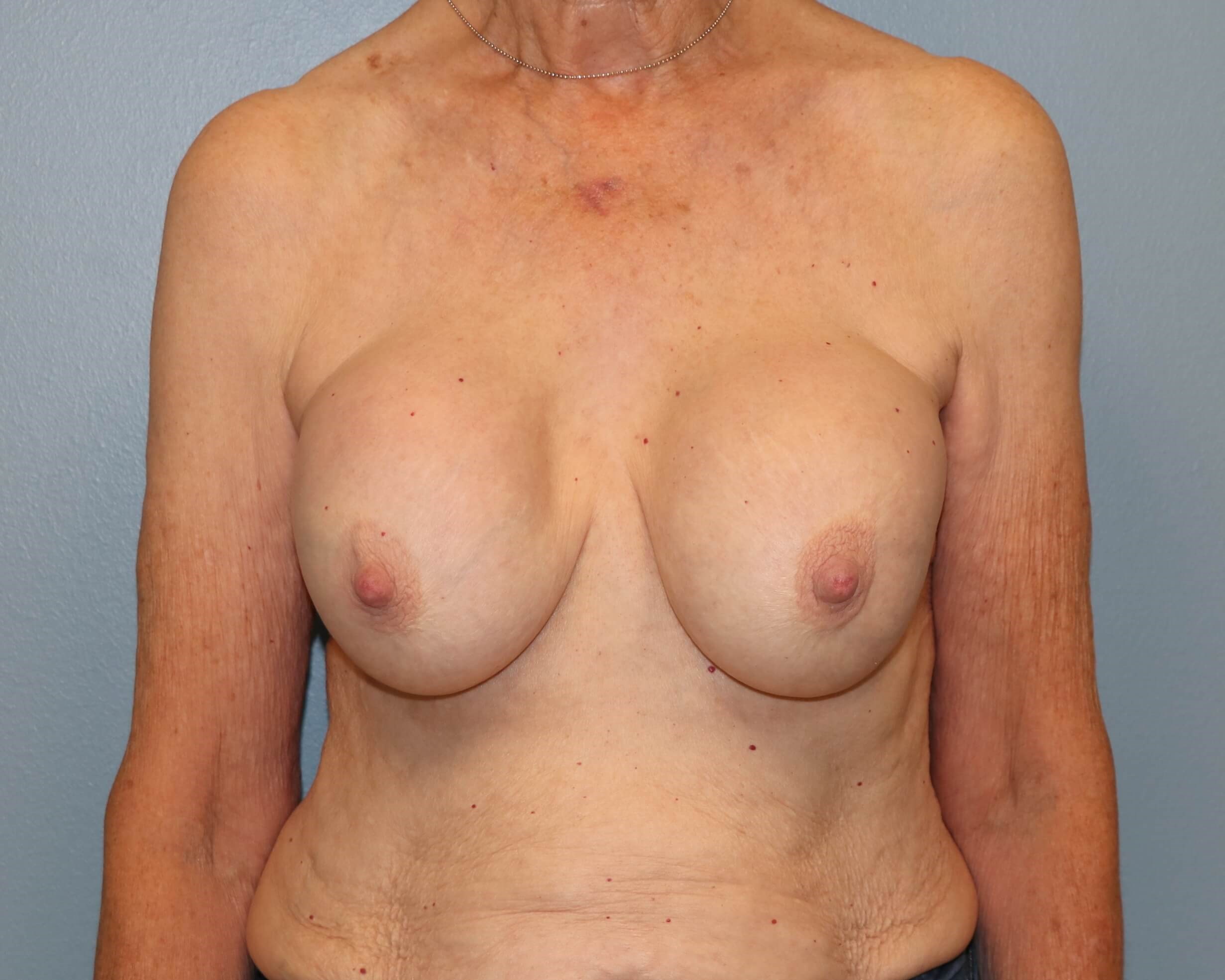 Capsulectomy, Implant Exchange Before Implant Replacement
