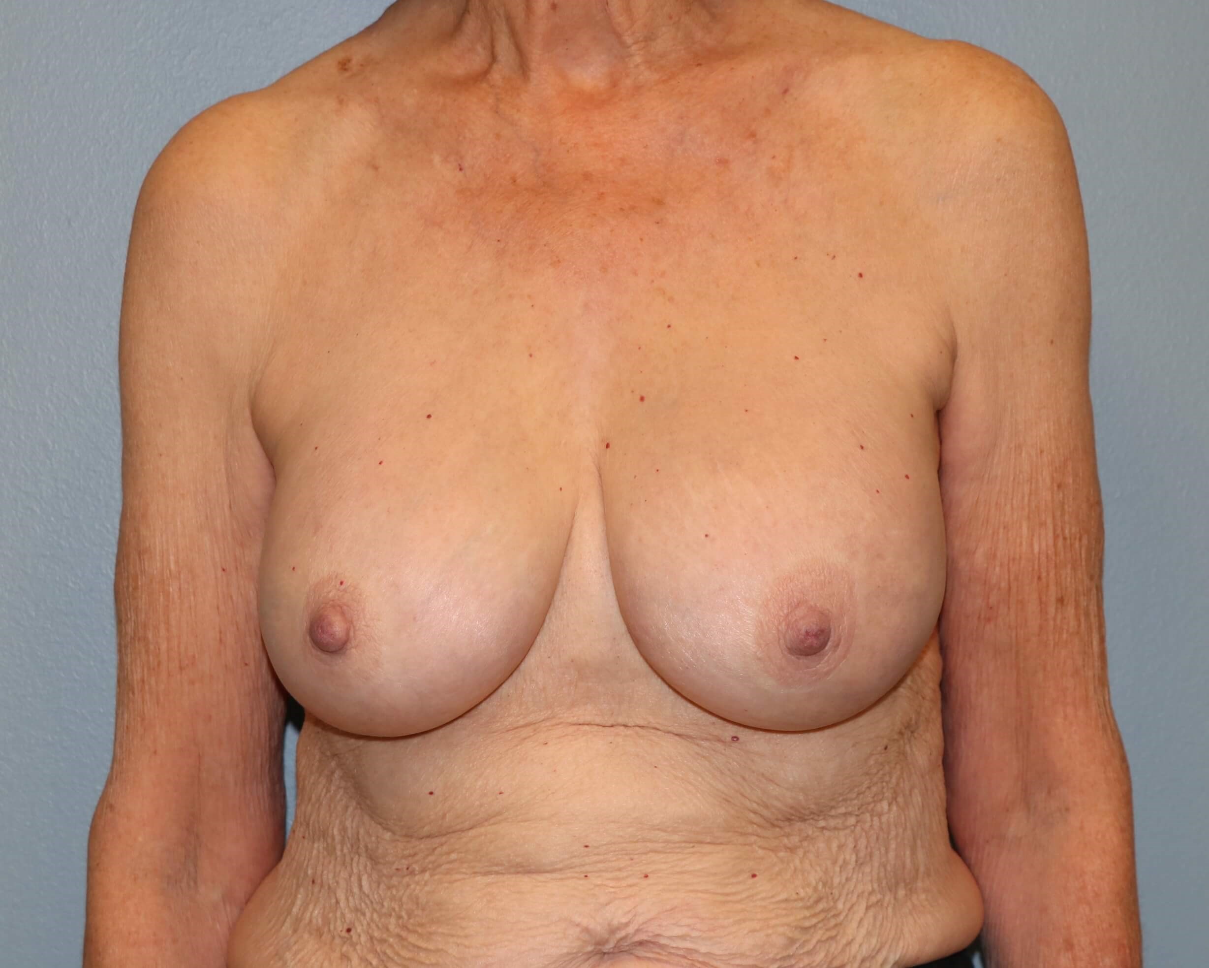 Capsulectomy, Implant Exchange After Implant Replacement