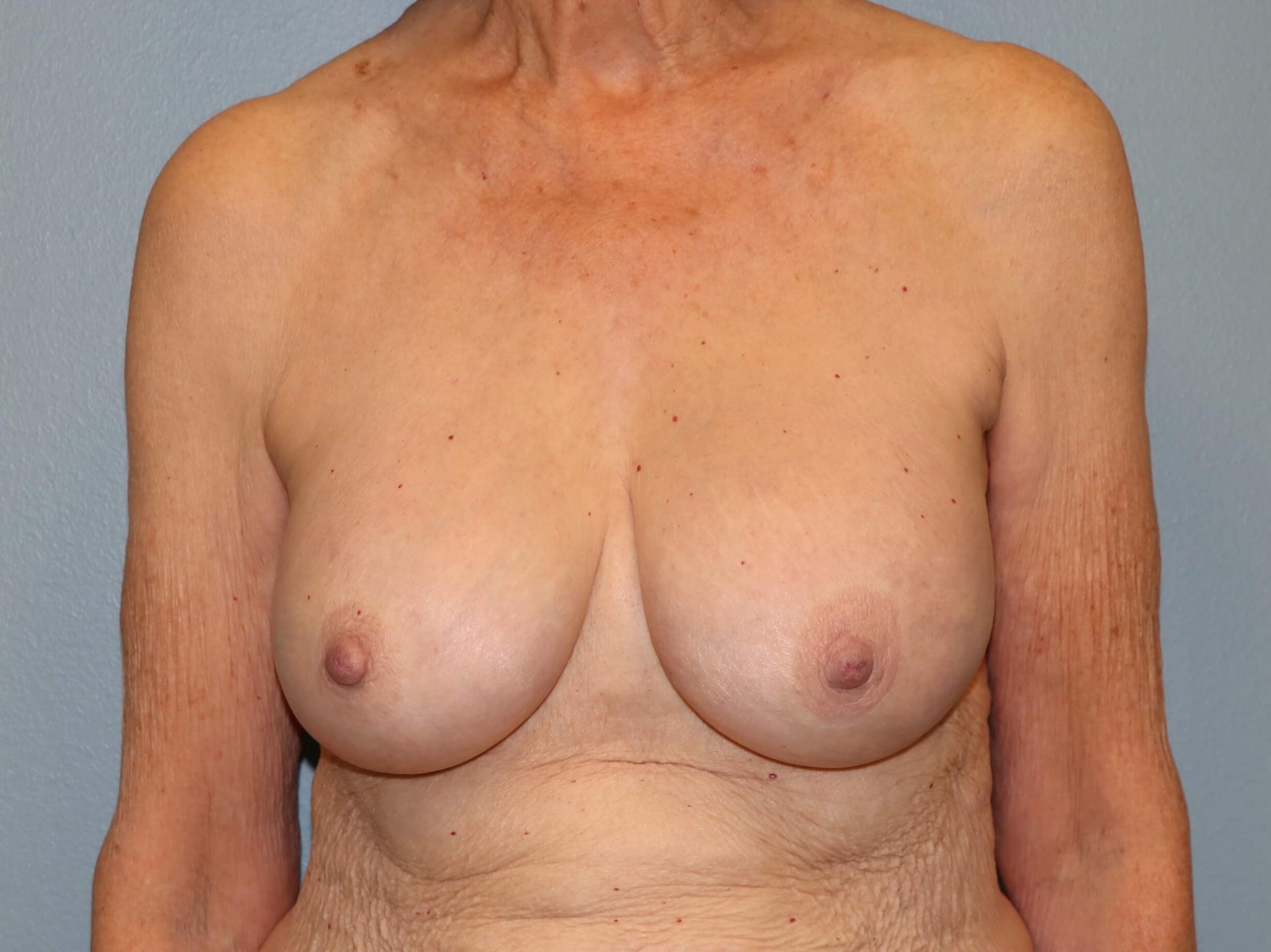 Capsulectomy, Implant Exchange After Implant Replacement