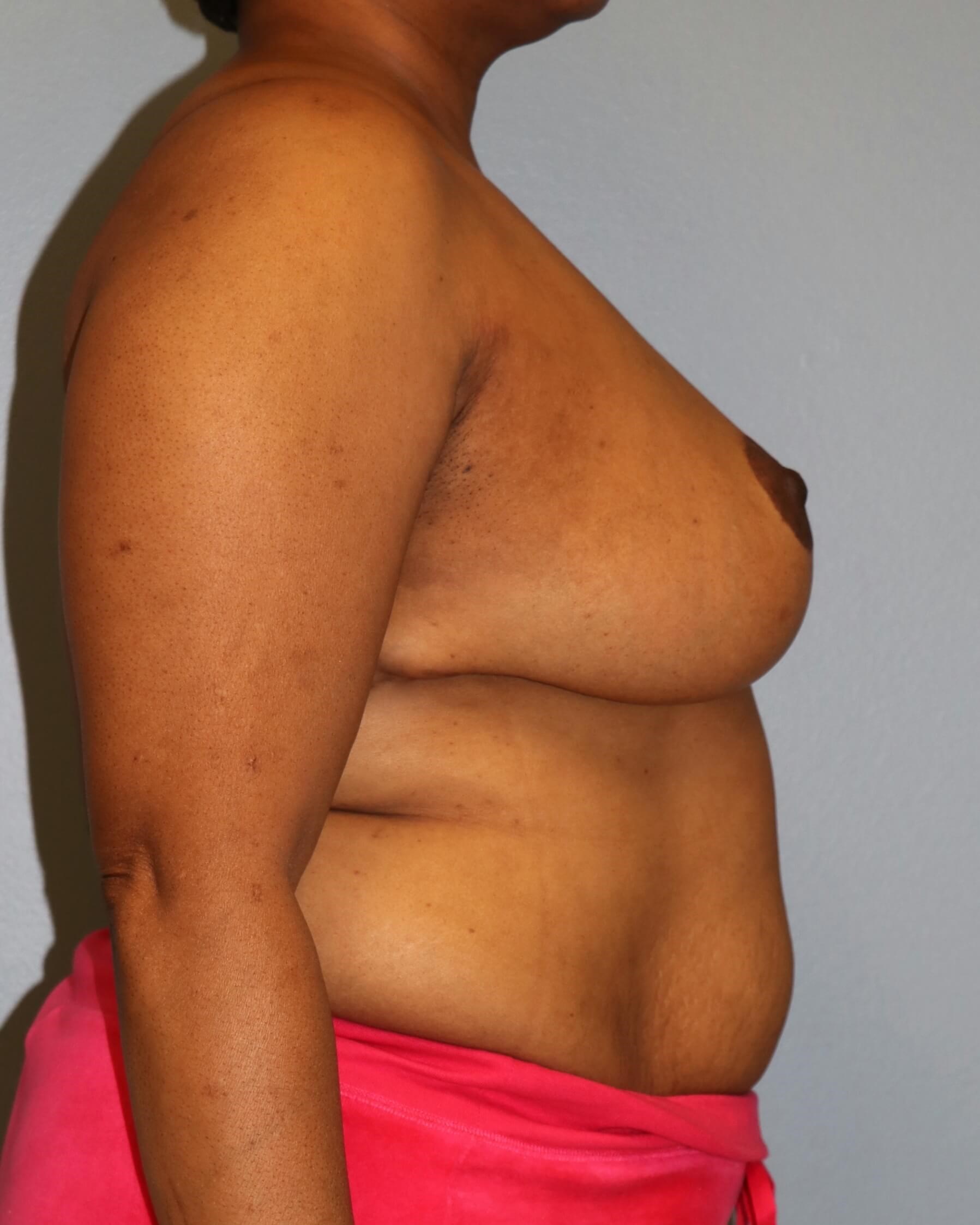 Breast Lift with Lumpectomy After Oncoplastic Mastopexy