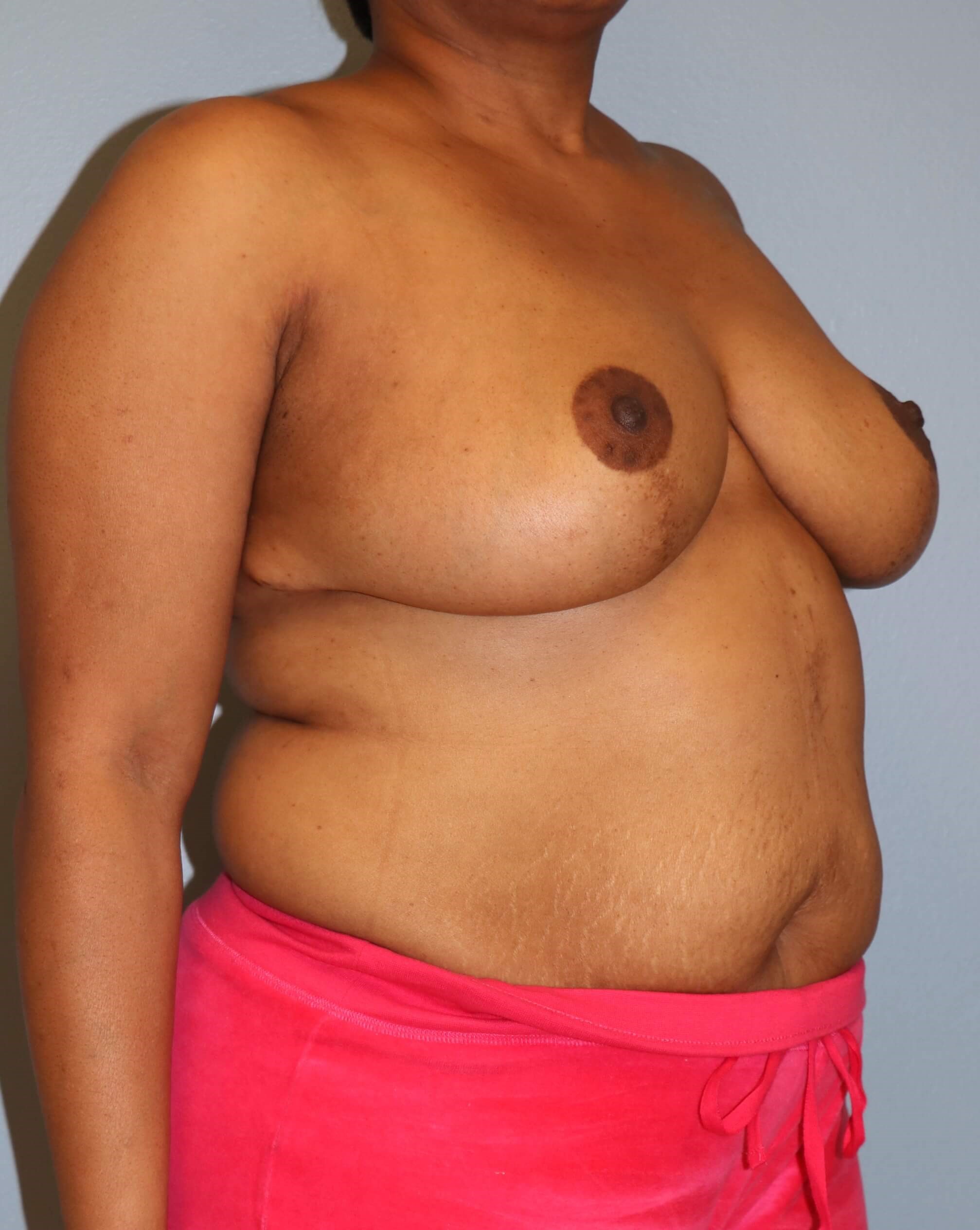 Breast Lift with Lumpectomy After Oncoplastic Mastopexy