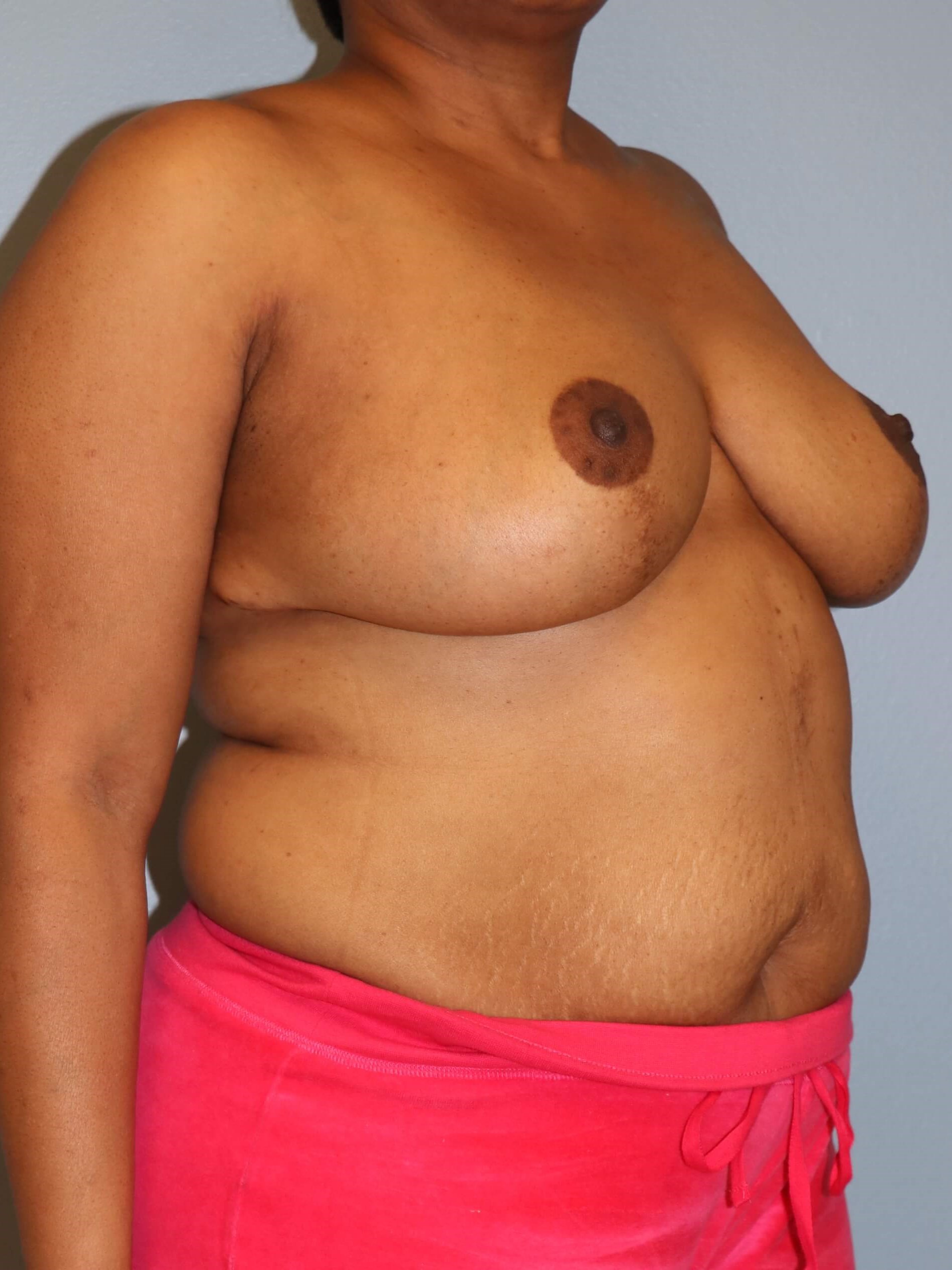 Breast Lift with Lumpectomy After Oncoplastic Mastopexy