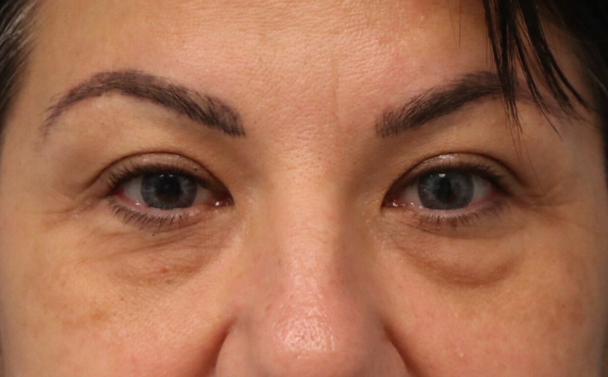 Lower Eyelid Blepharoplasty Before Lower Blepharoplasty