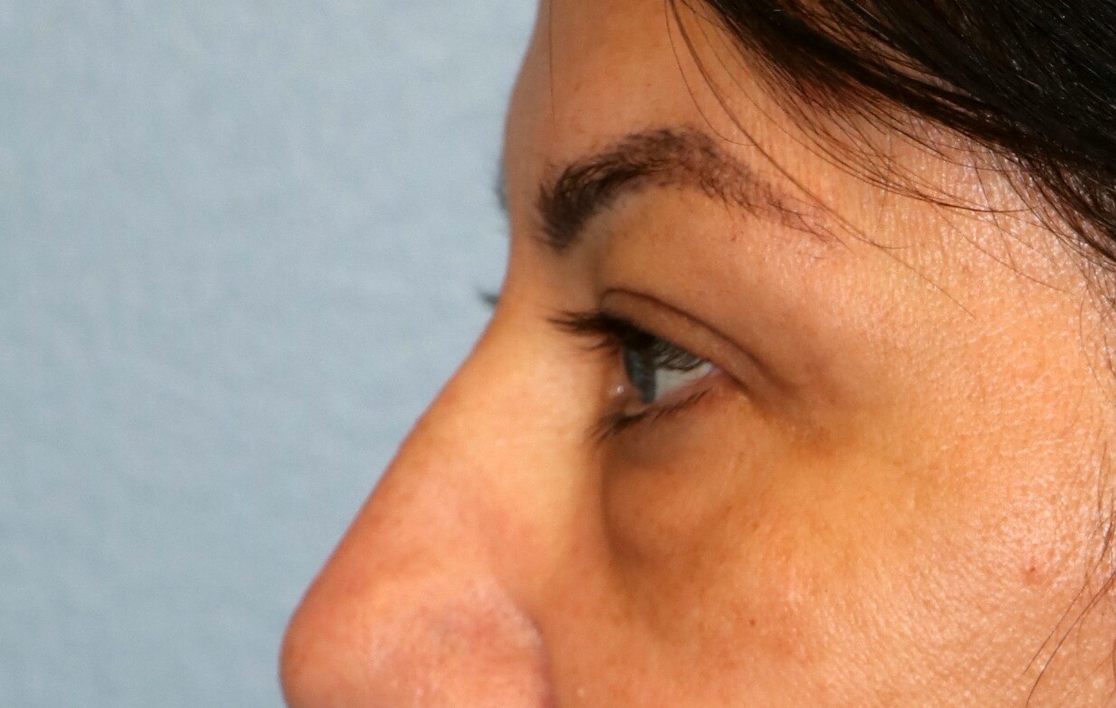 Lower Eyelid Blepharoplasty Before Lower Blepharoplasty