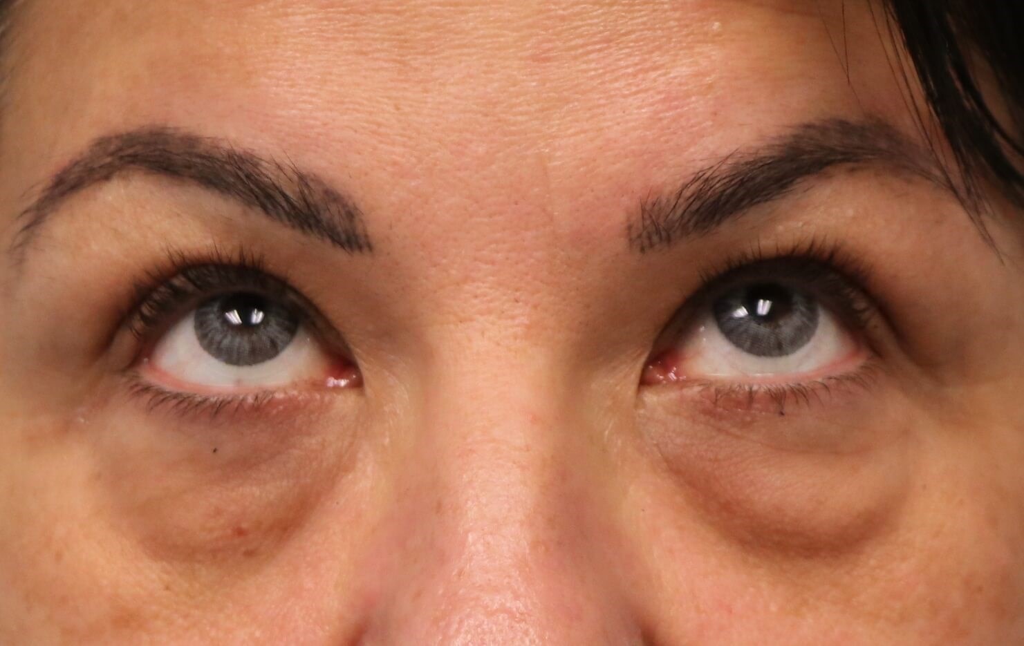 Lower Eyelid Blepharoplasty Before Lower Blepharoplasty