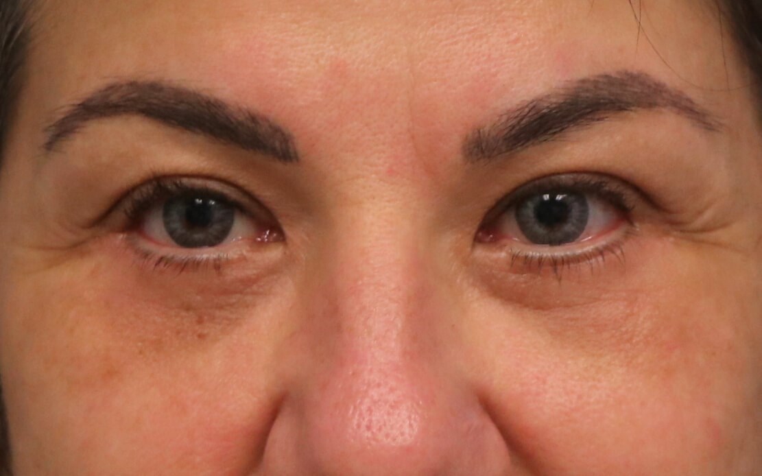Lower Eyelid Blepharoplasty After Lower Blepharoplasty