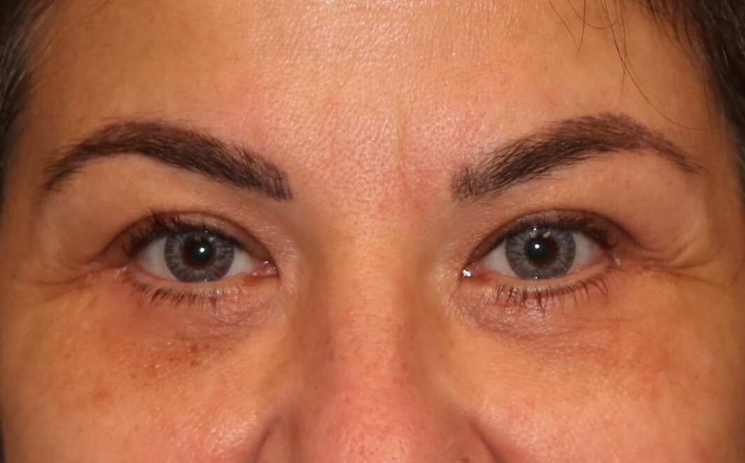 Lower Eyelid Blepharoplasty After Lower Blepharoplasty