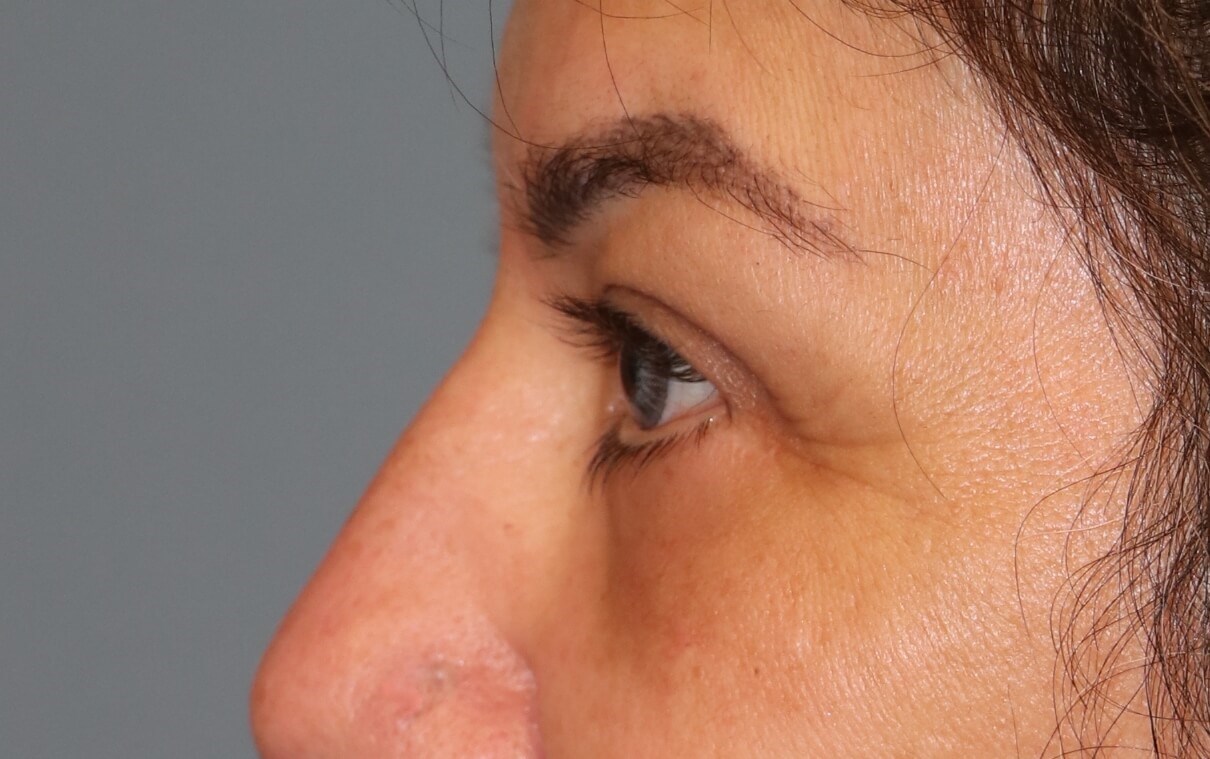 Lower Eyelid Blepharoplasty After Lower Blepharoplasty
