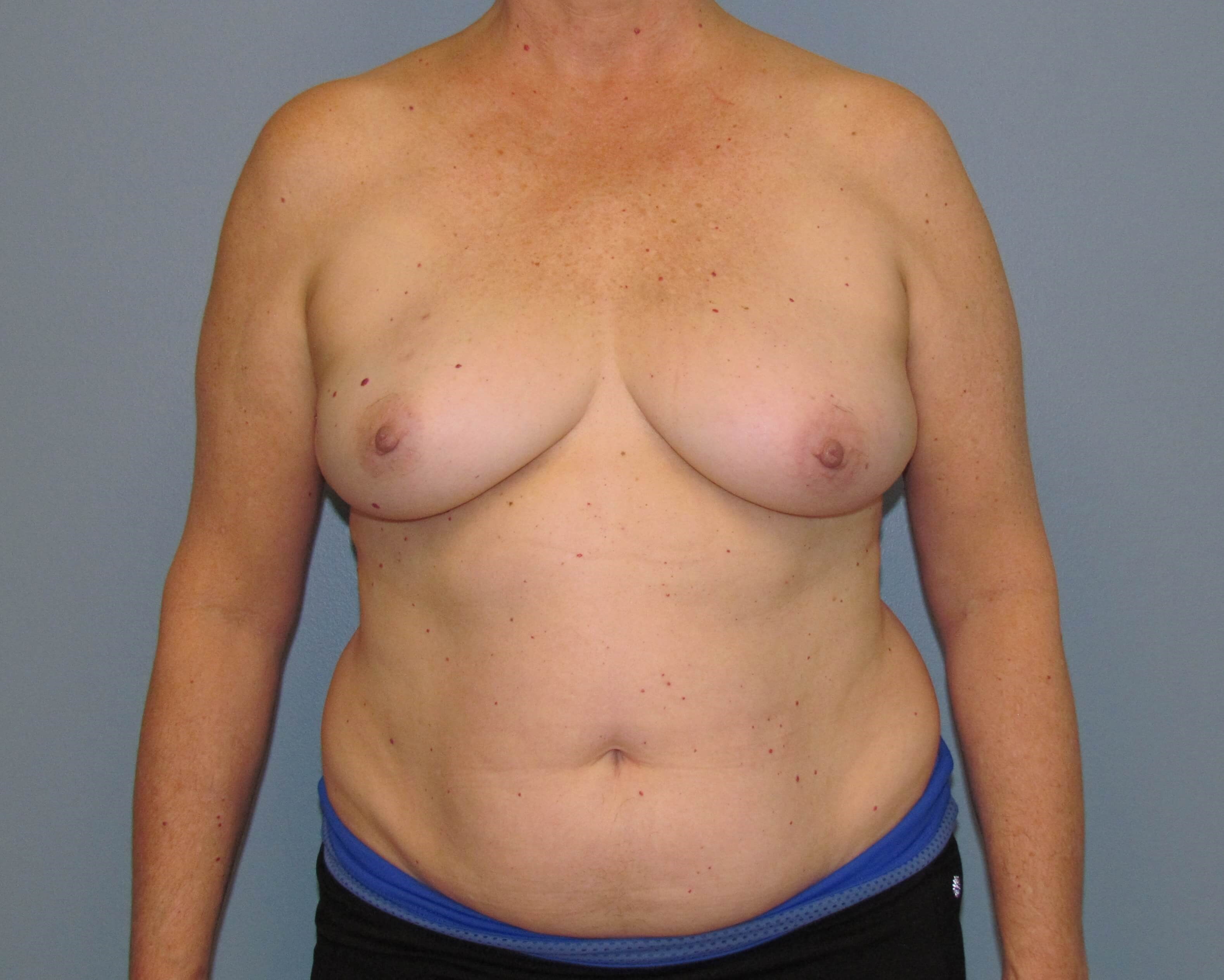 Right Breast DIEP Before/After Before Mastectomy & DIEP Flap