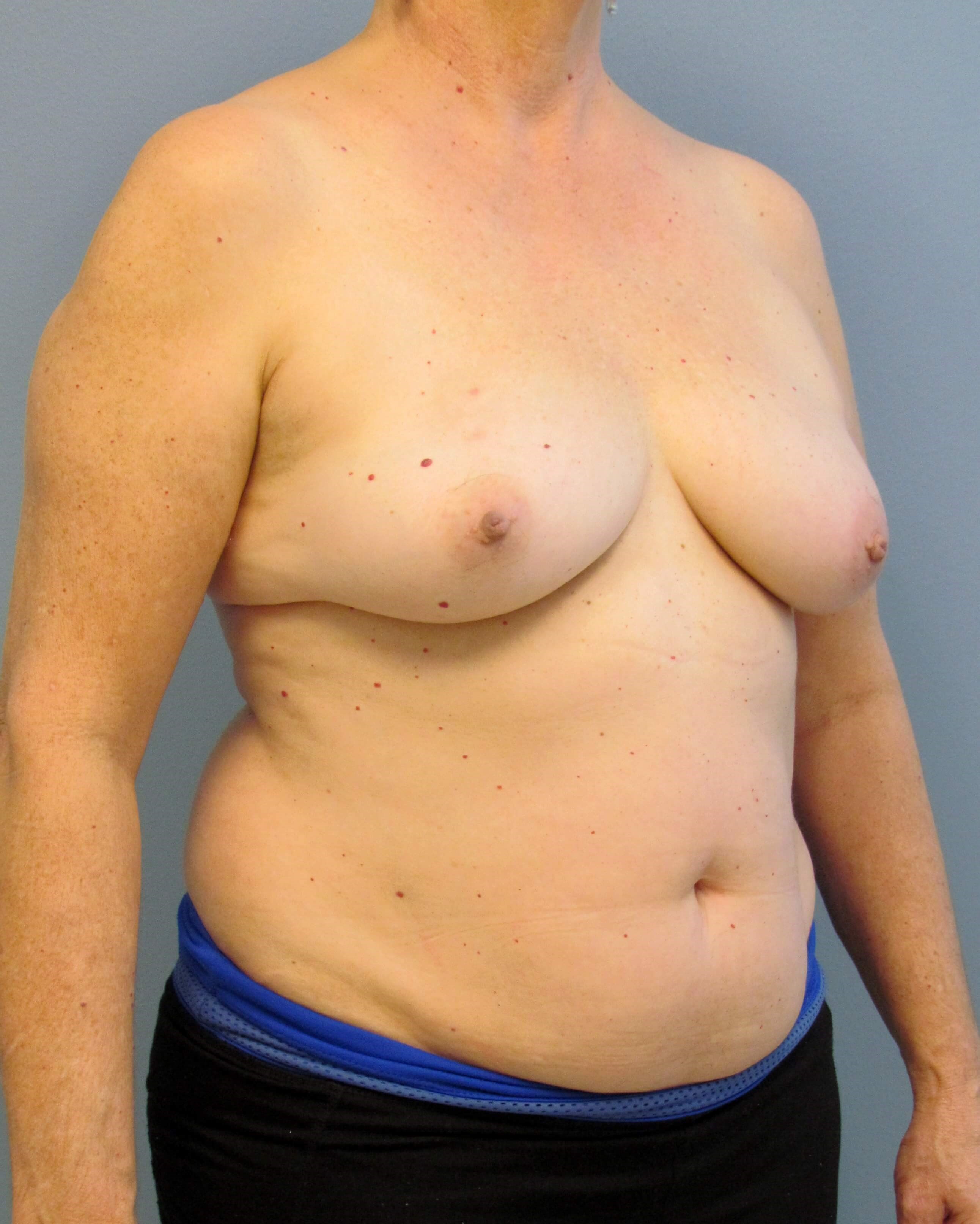 Right Breast DIEP Before/After Before Mastectomy & DIEP Flap