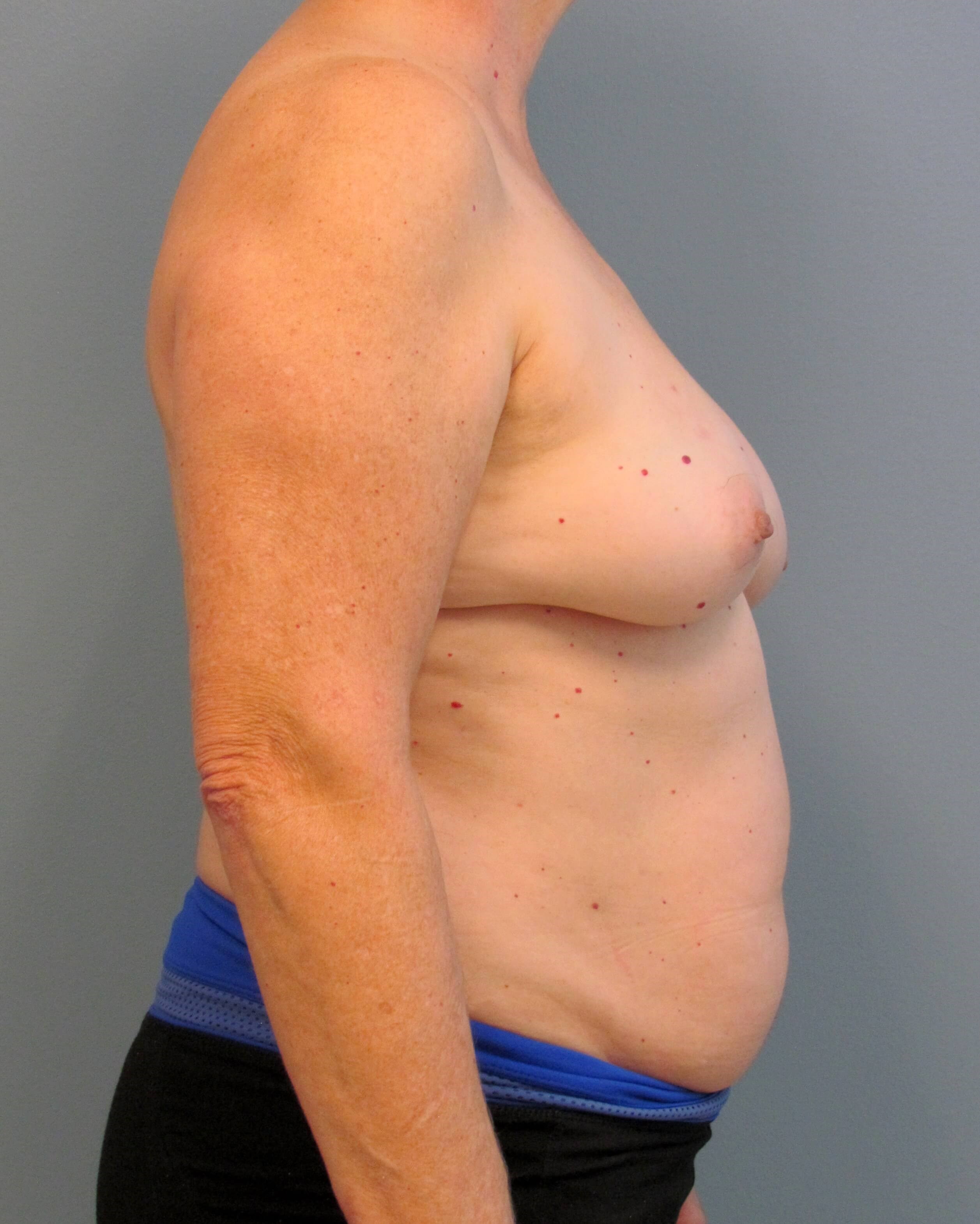 Right Breast DIEP Before/After Before Mastectomy & DIEP Flap