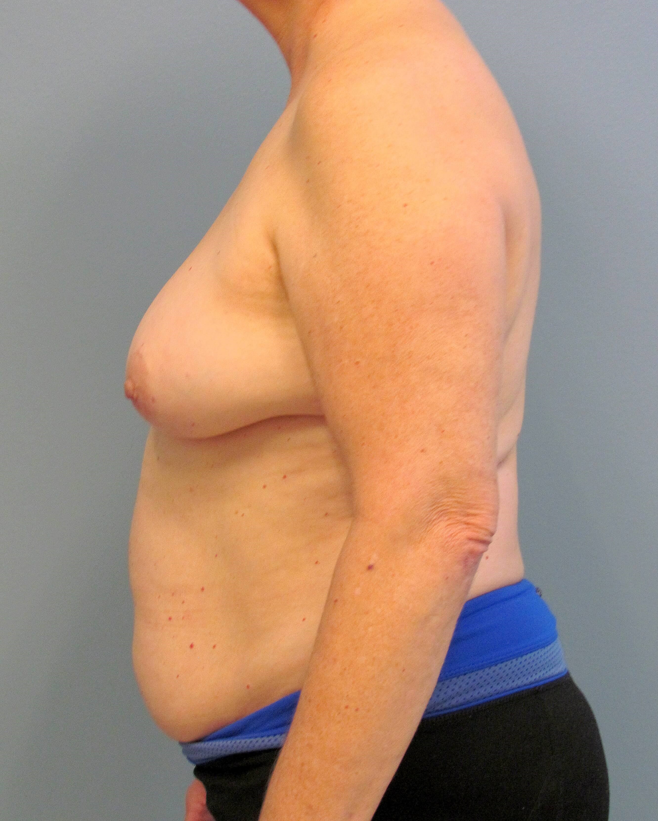 Right Breast DIEP Before/After Before Mastectomy & DIEP Flap