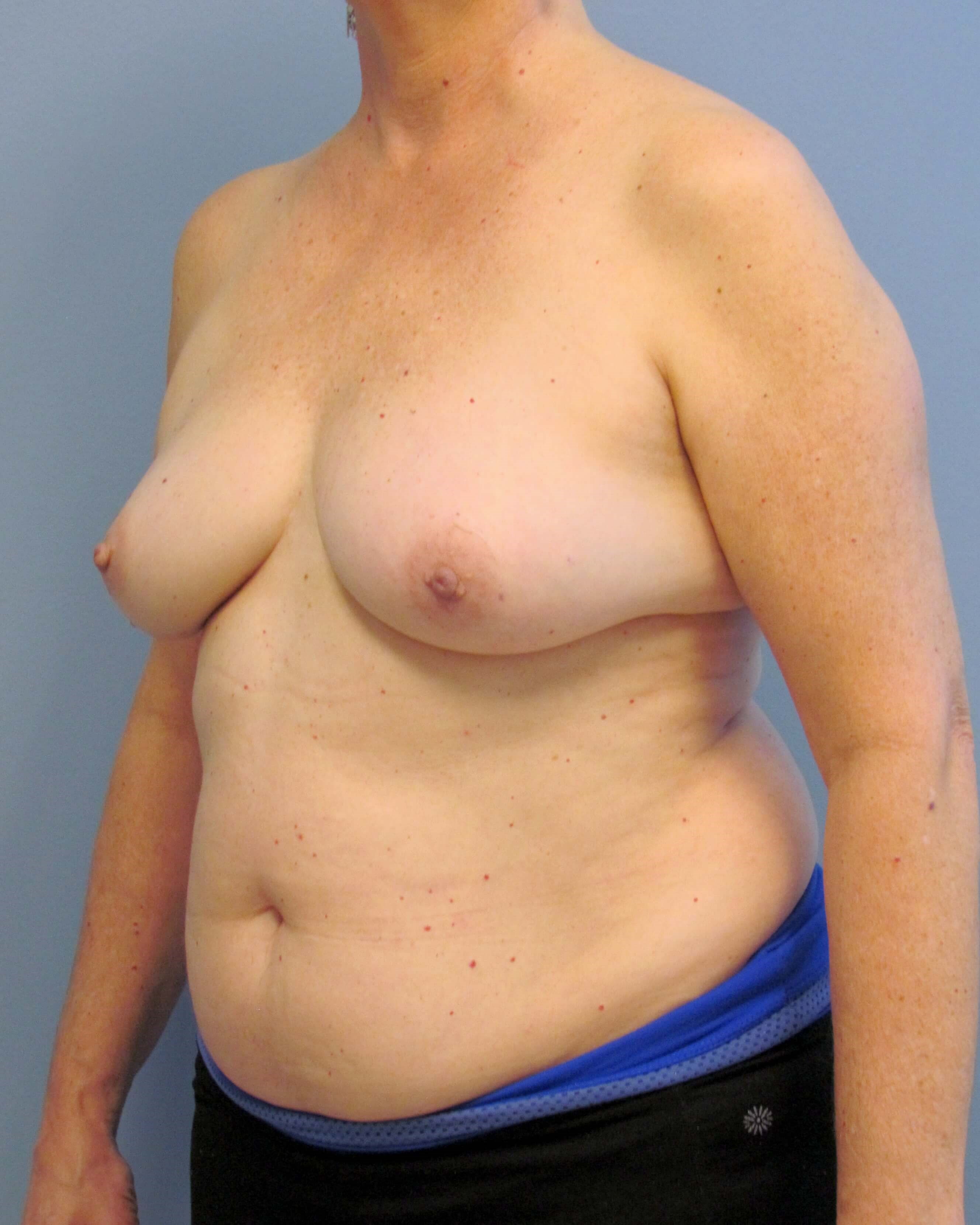 Right Breast DIEP Before/After Before Mastectomy & DIEP Flap