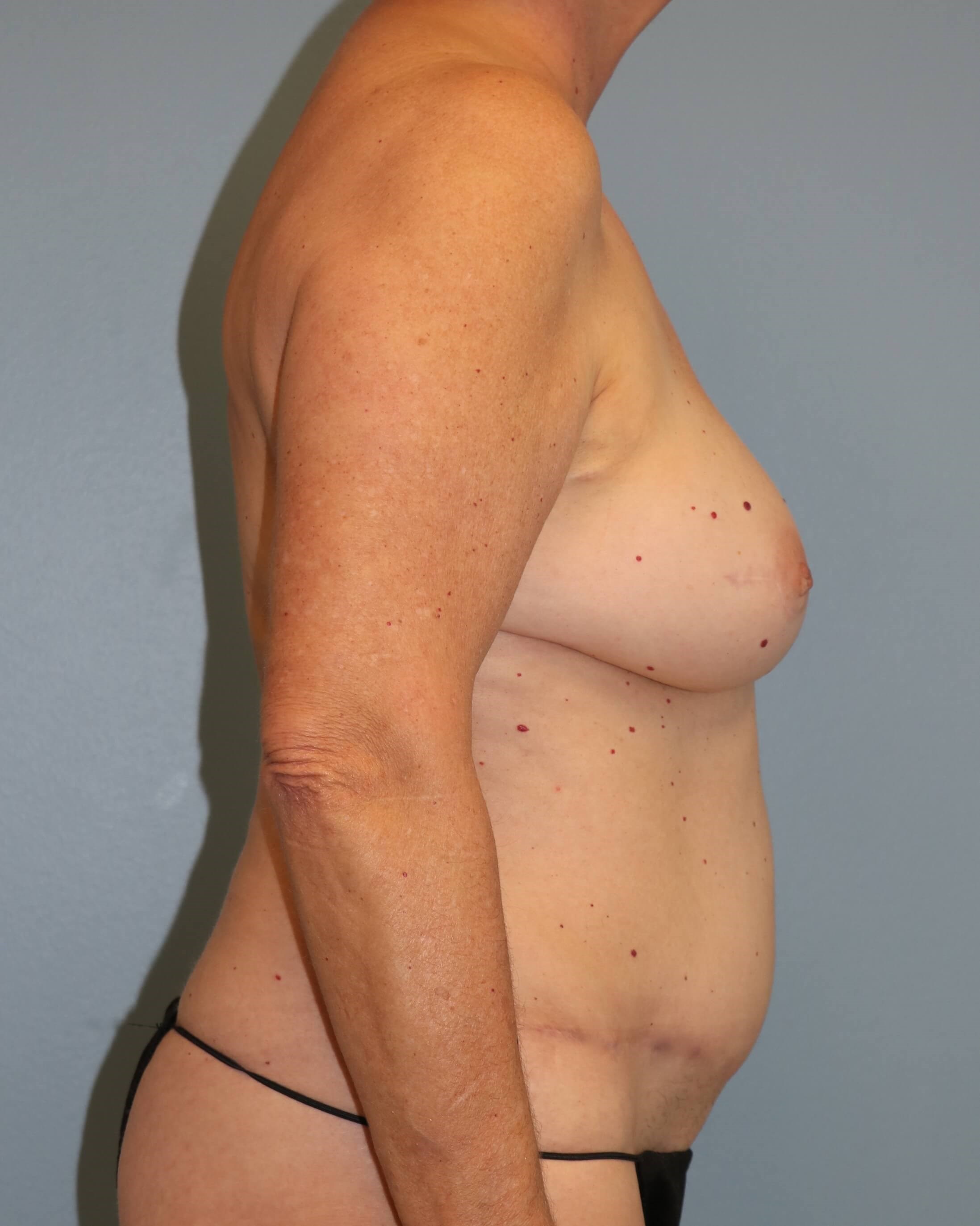 Right Breast DIEP Before/After After Mastectomy & DIEP Flap