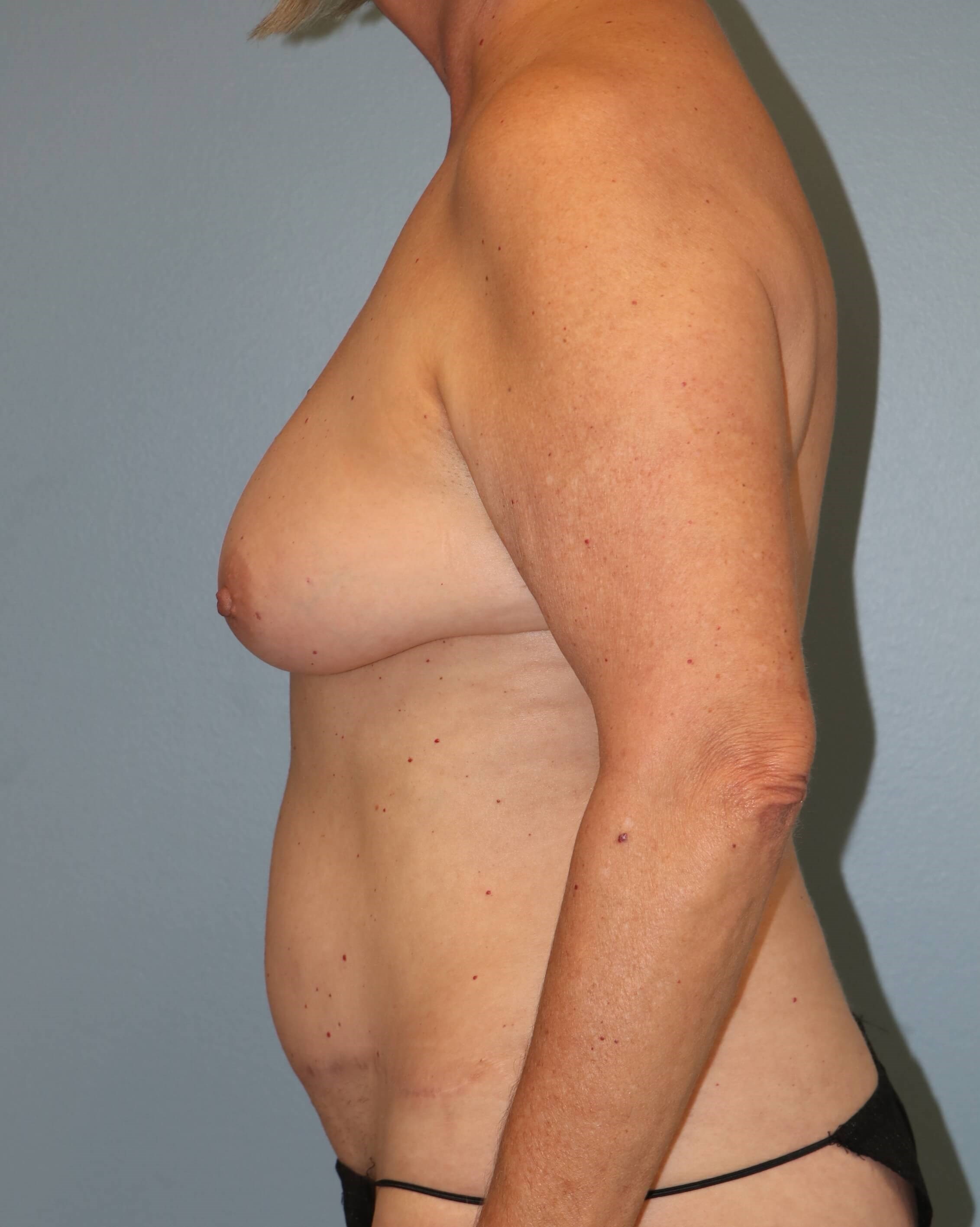 Right Breast DIEP Before/After After Mastectomy & DIEP Flap