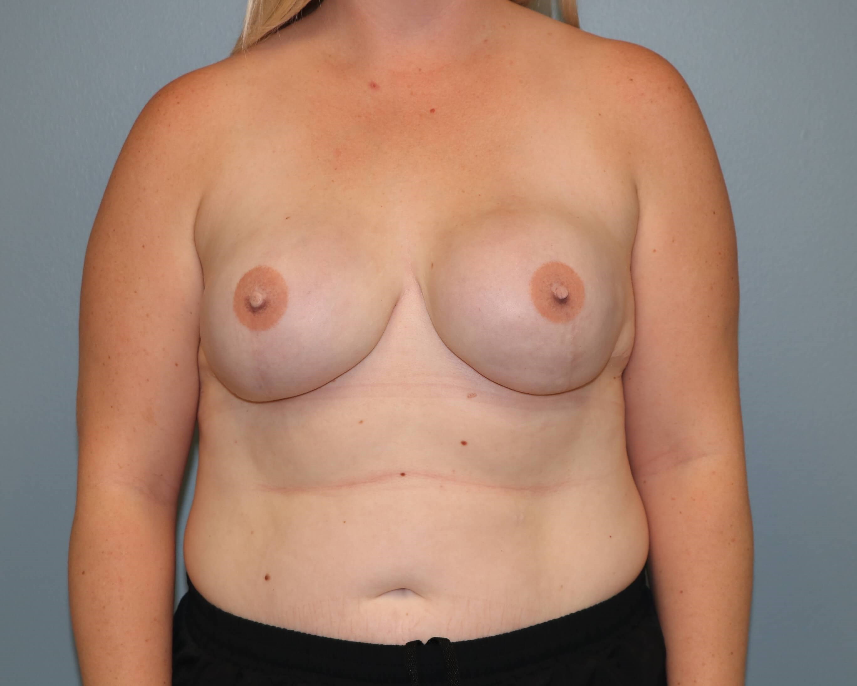 Implant Reconstruction Results After Implant Reconstruction
