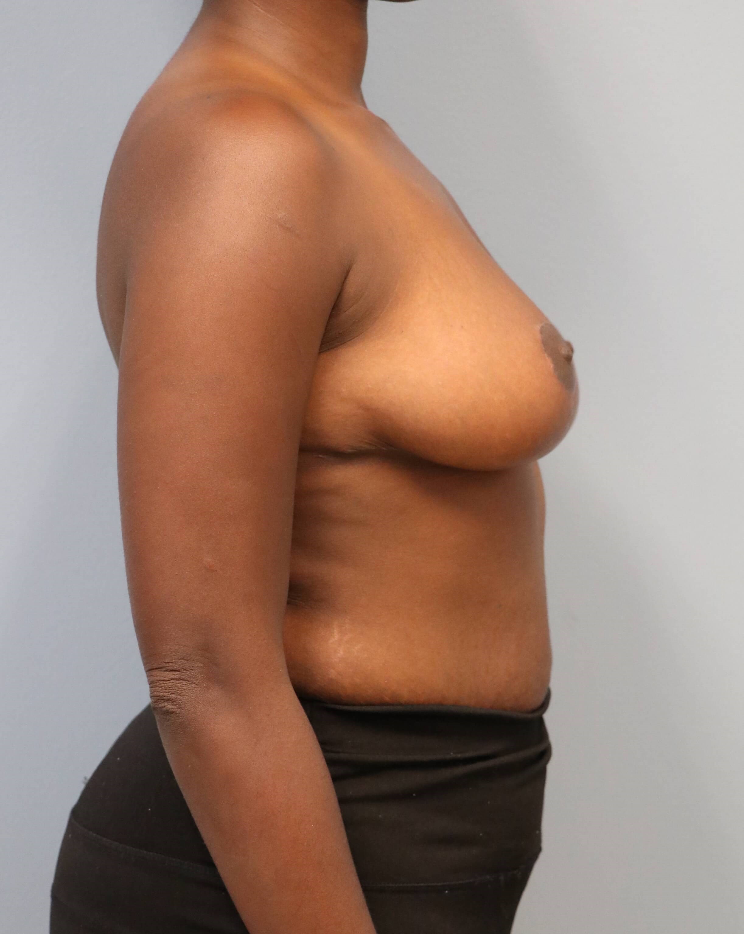 Breast Reduction Before/After After Breast Reduction