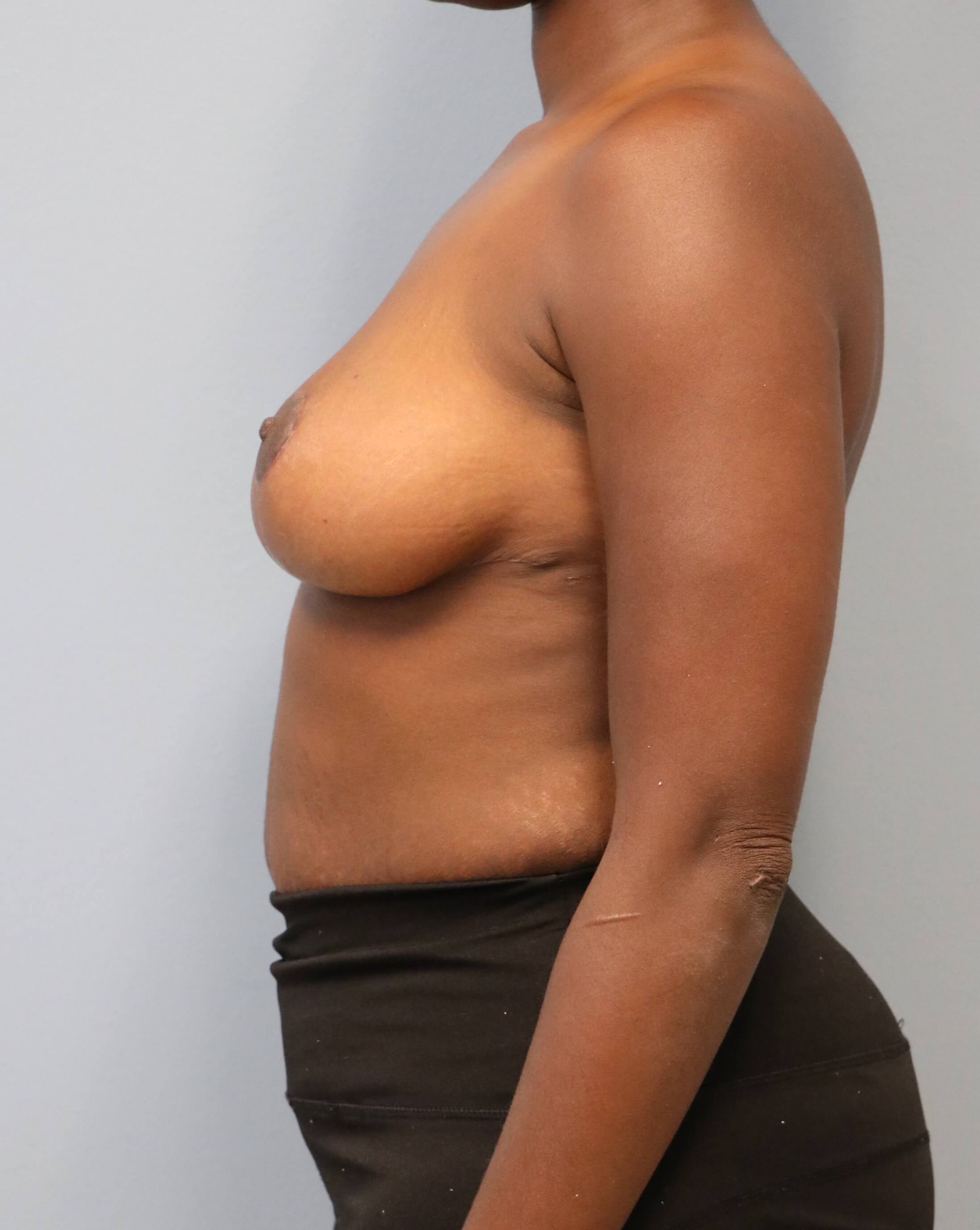 Breast Reduction Before/After After Breast Reduction