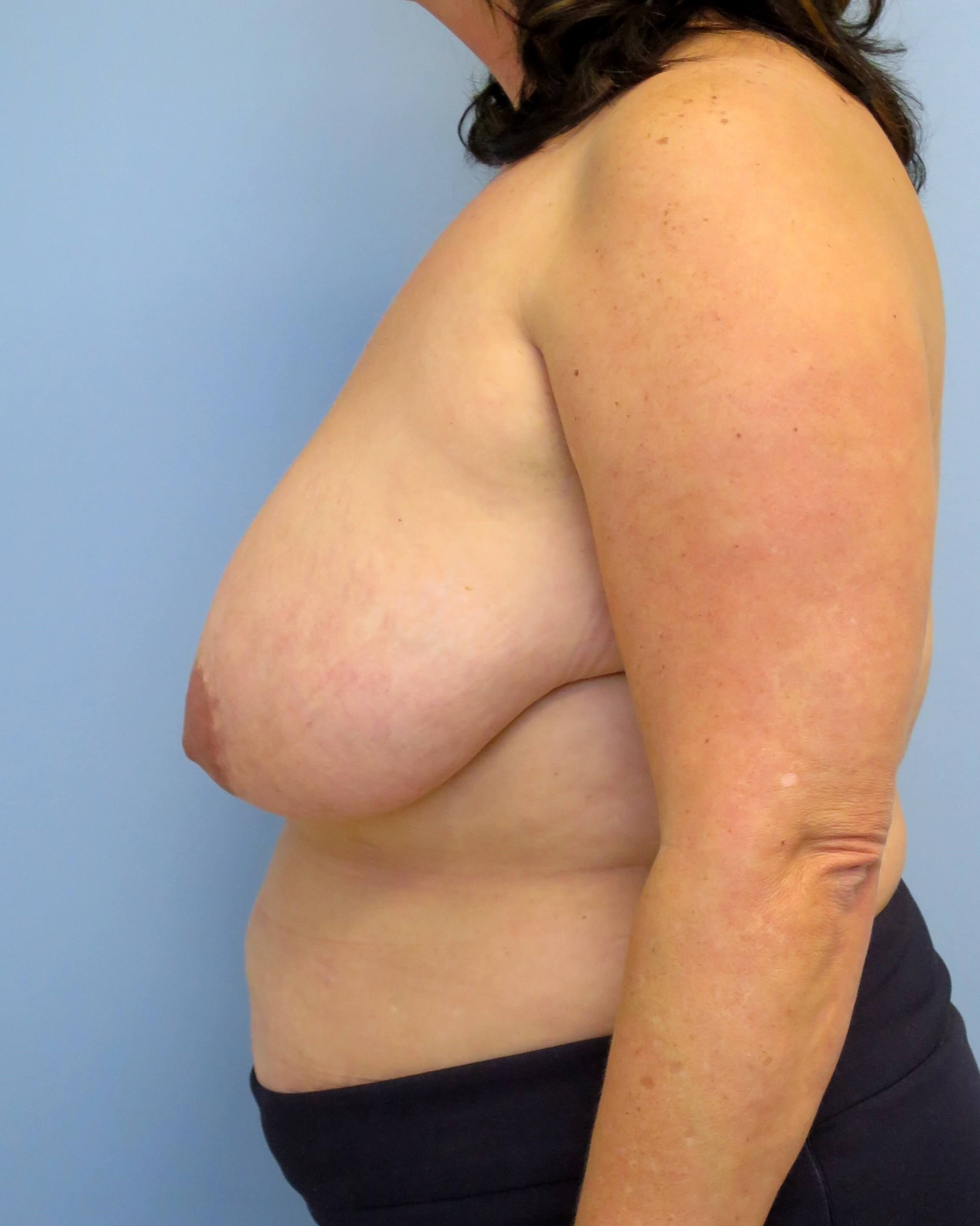 Breast Lift & Lipo Results Before Breast Lift & Lipo