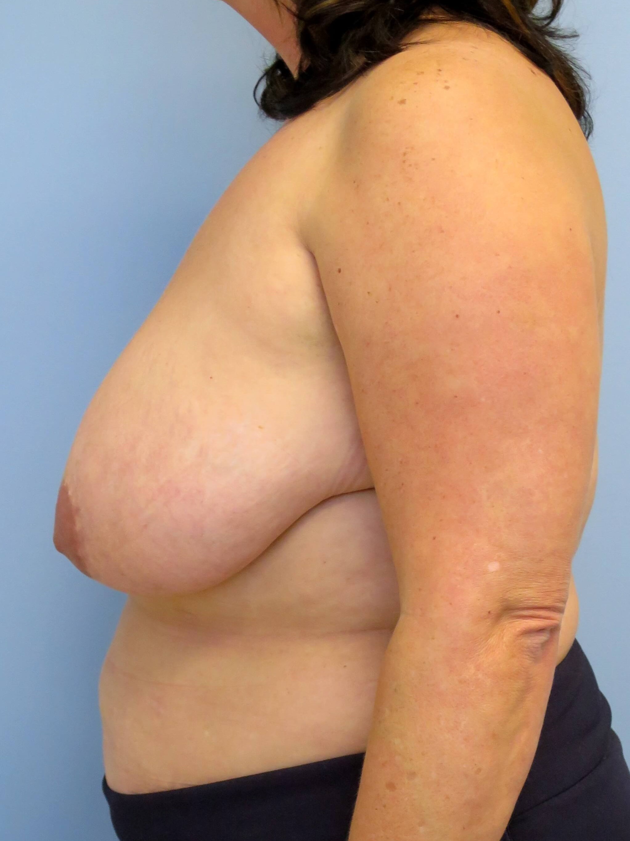 Breast Lift & Lipo Results Before Breast Lift & Lipo