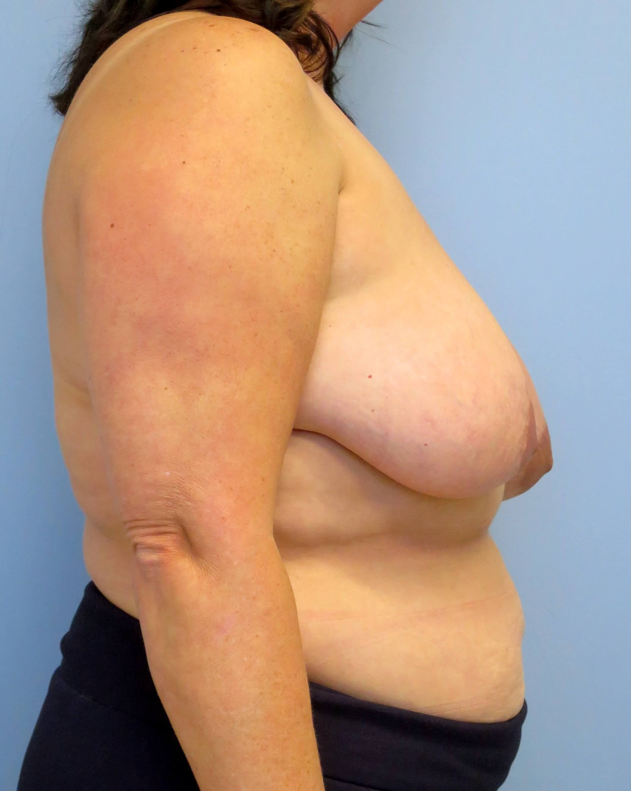Breast Lift & Lipo Results Before Breast Lift & Lipo