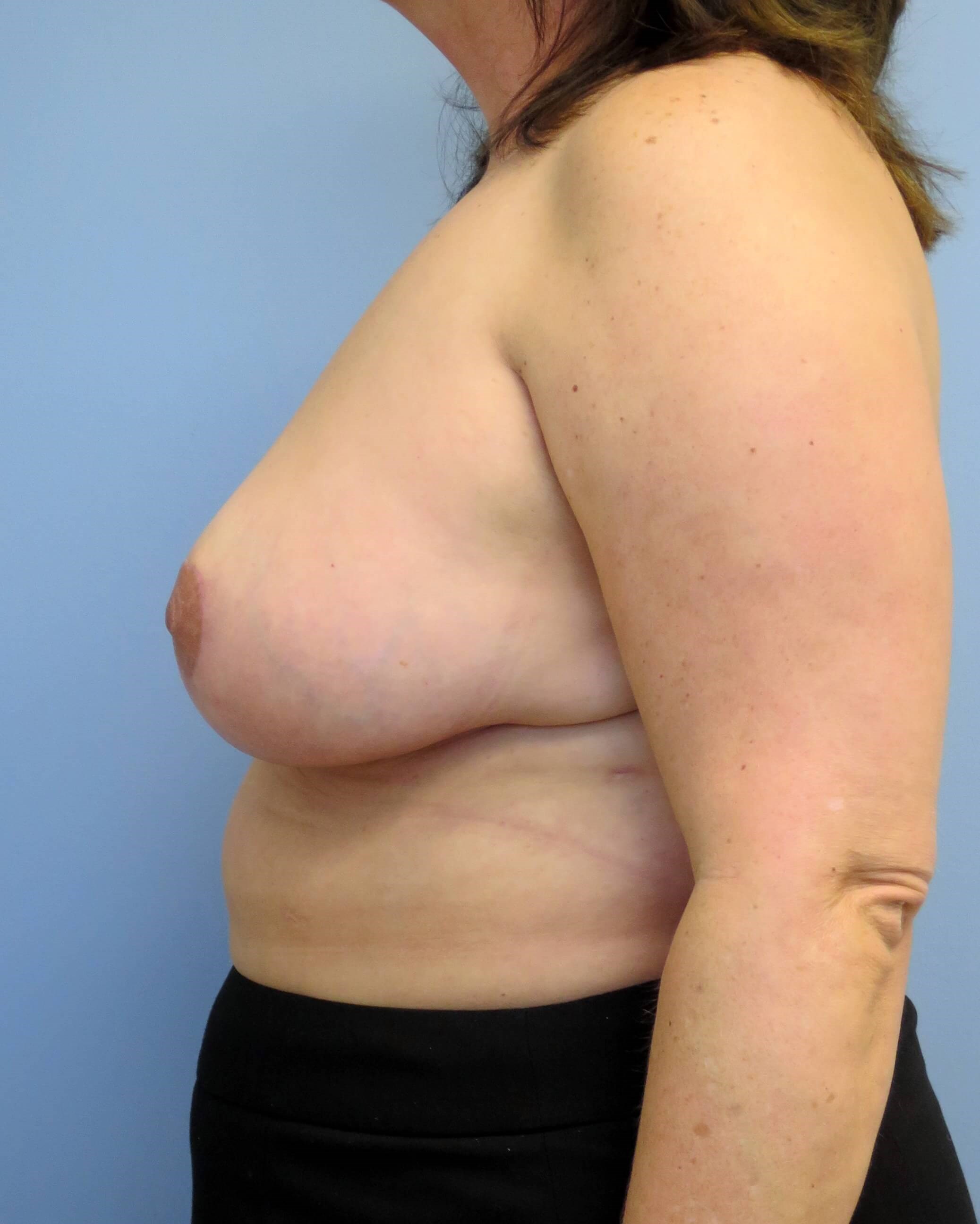 Breast Lift & Lipo Results After Breast Lift & Lipo