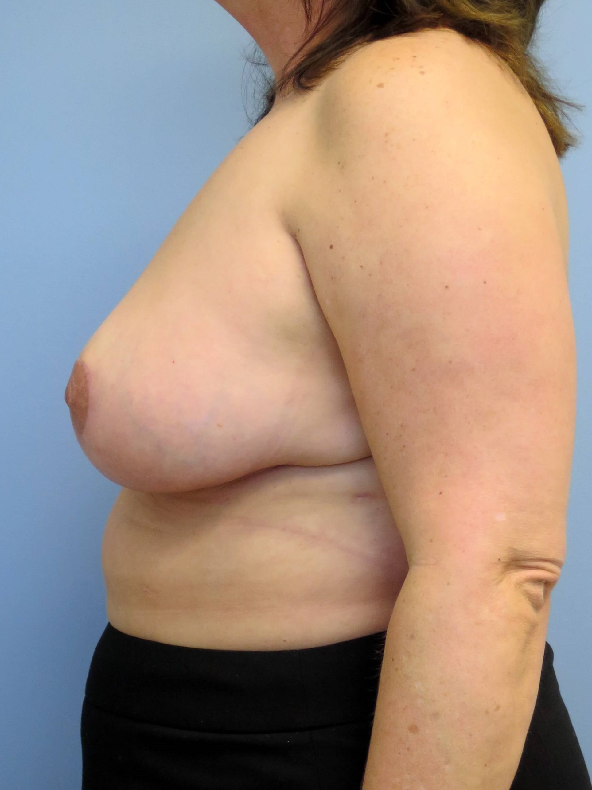Breast Lift & Lipo Results After Breast Lift & Lipo