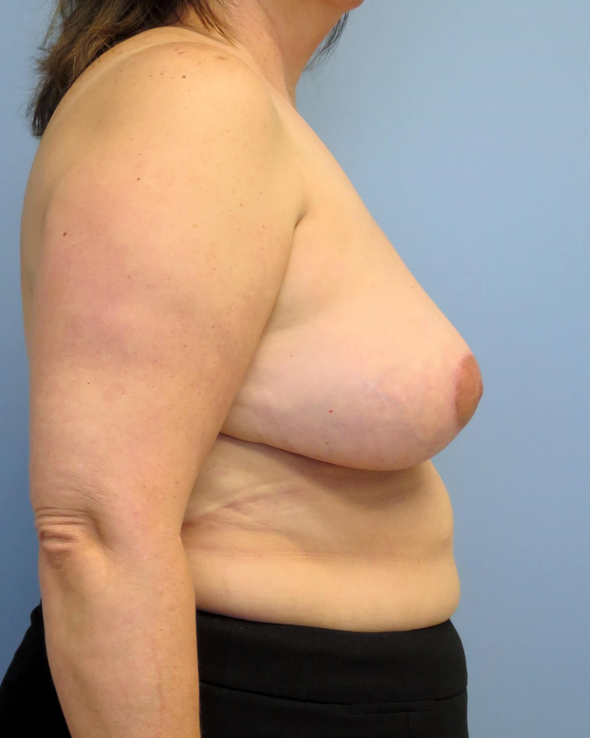 Breast Lift & Lipo Results After Breast Lift & Lipo