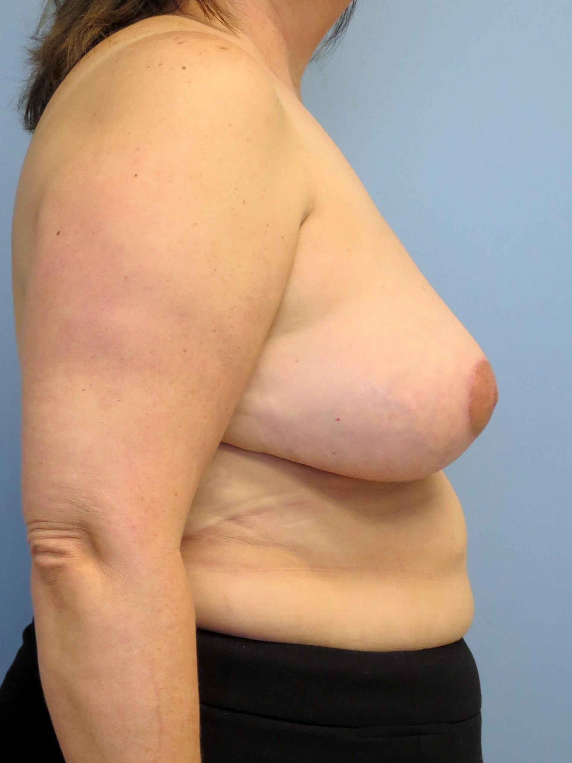 Breast Lift & Lipo Results After Breast Lift & Lipo