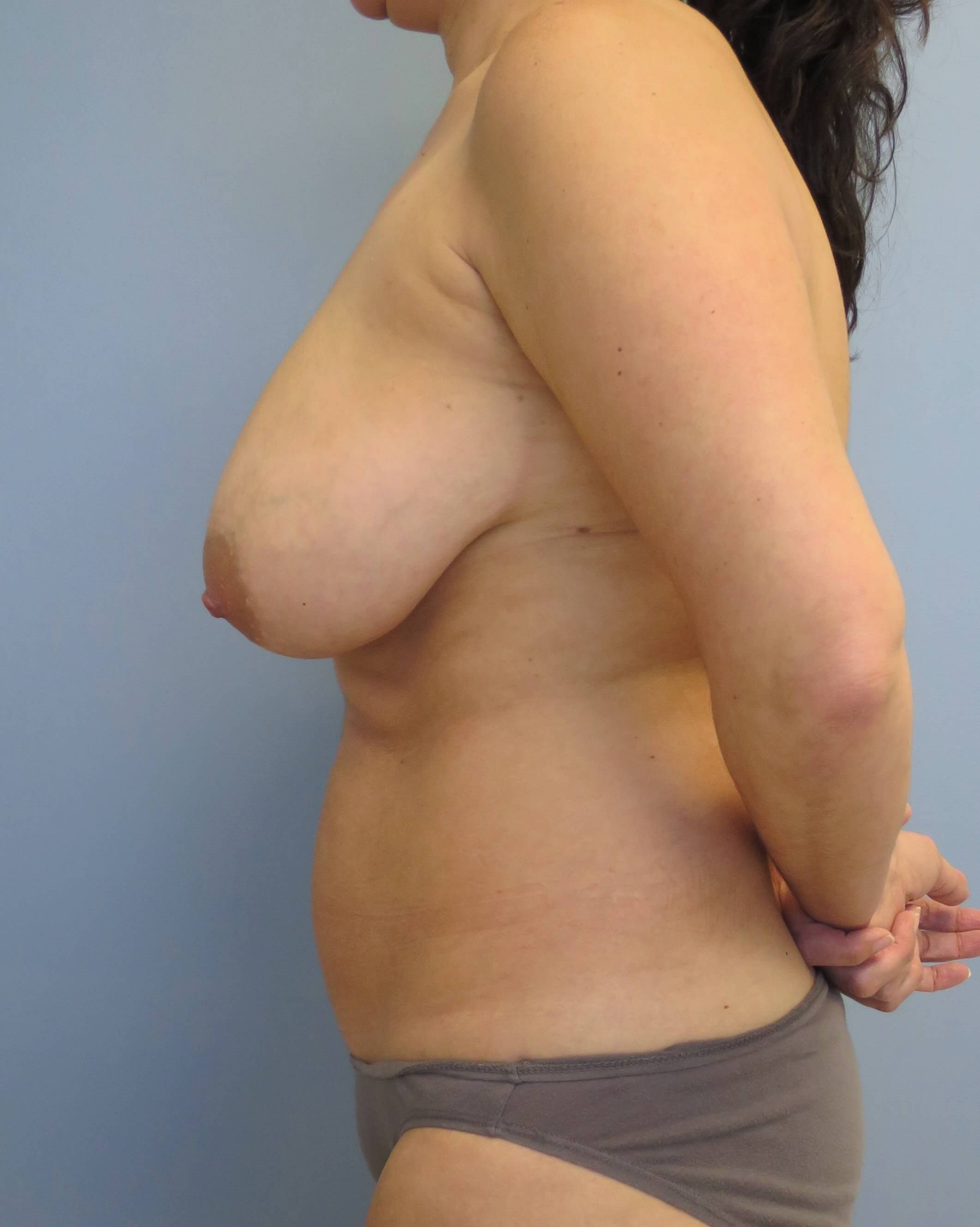 Mommy Makeover Before & After Before Mommy Makeover