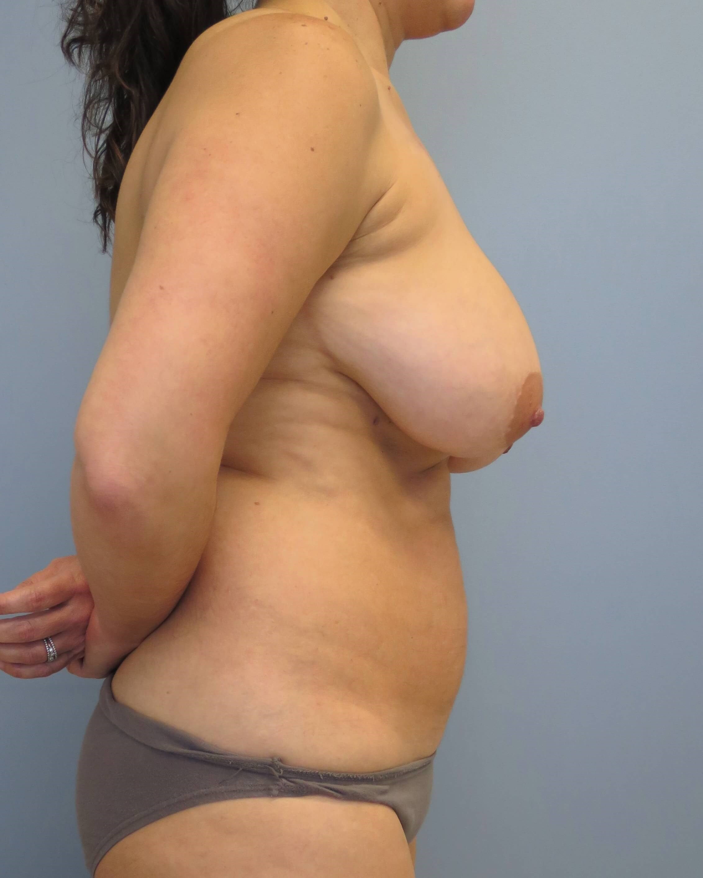 Mommy Makeover Before & After Before Mommy Makeover