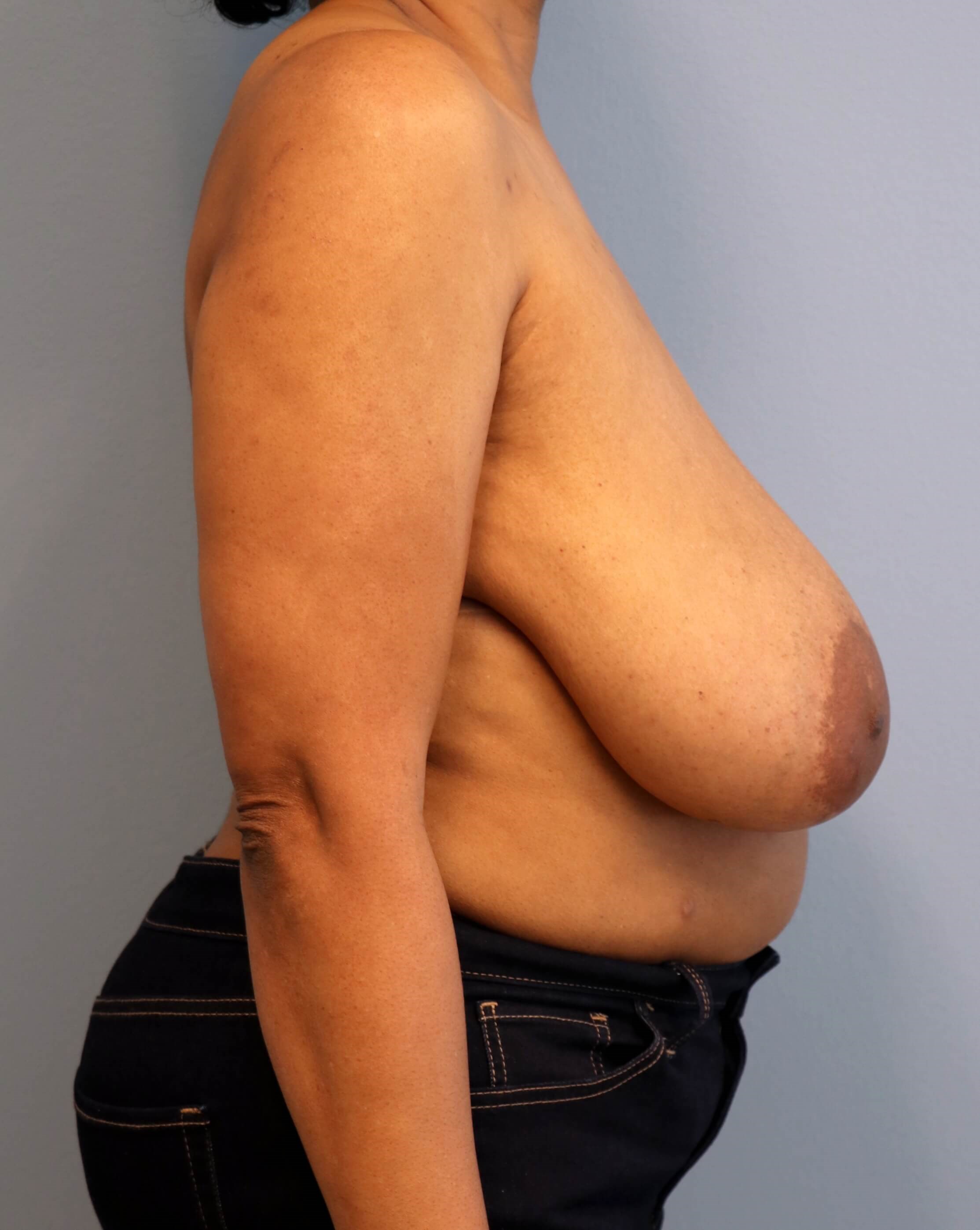 Breast Reduction Before/After Before Breast Reduction