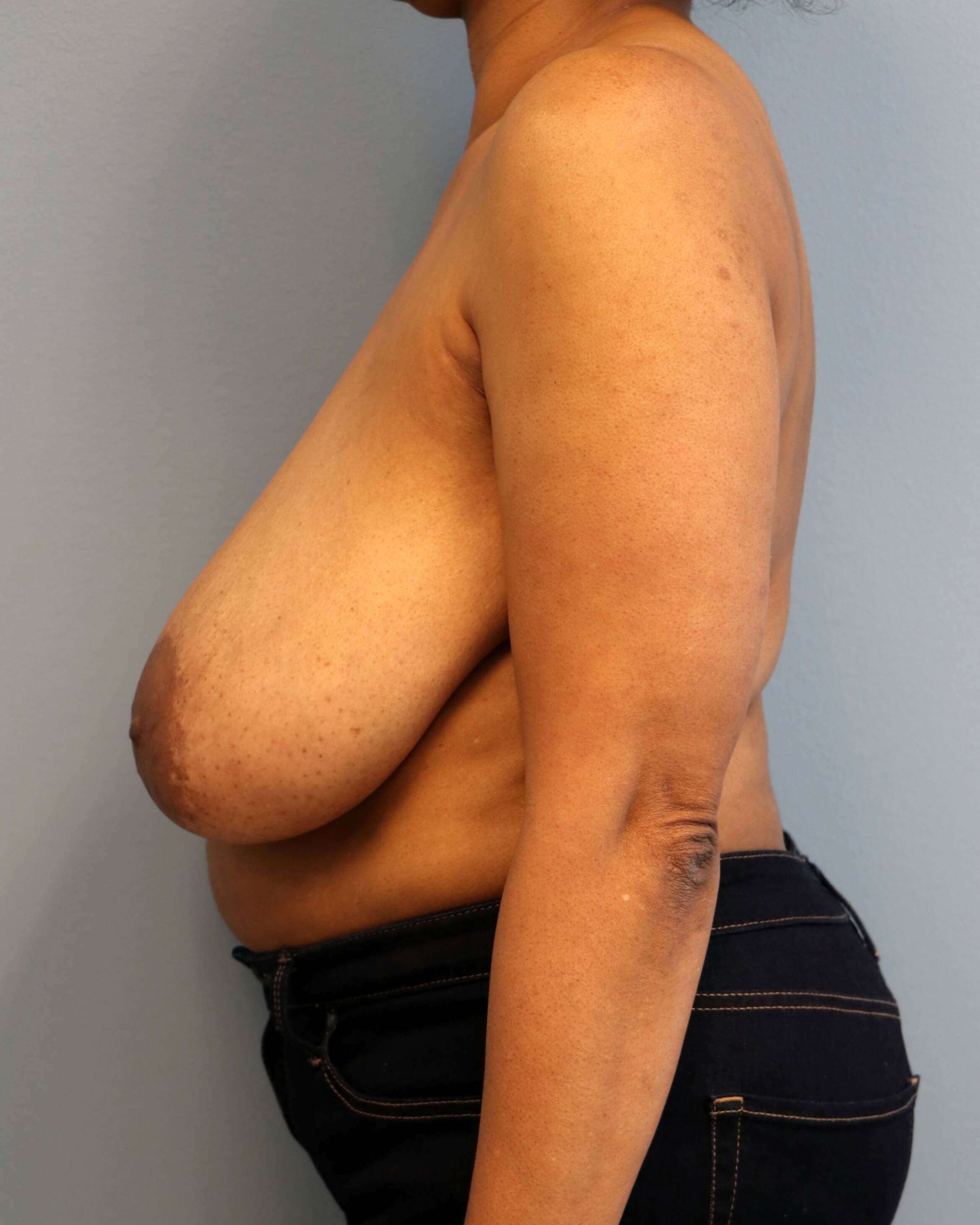 Breast Reduction Before/After Before Breast Reduction