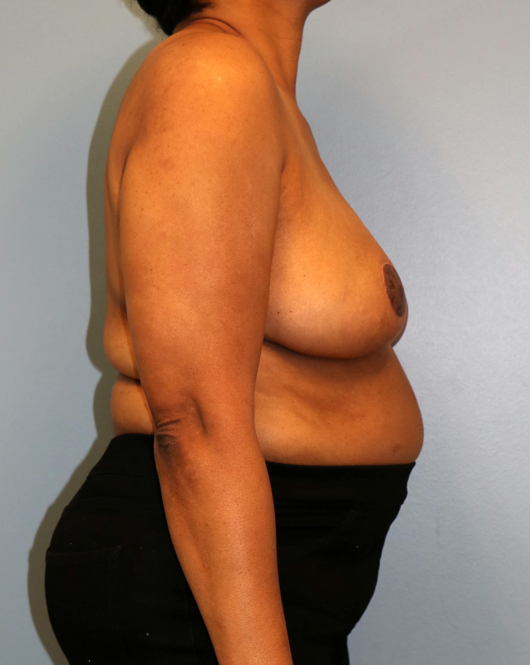 Breast Reduction Before/After After Breast Reduction