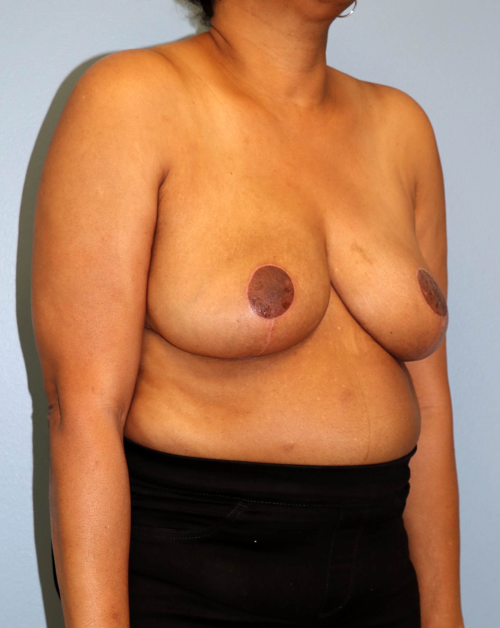 Breast Reduction Before/After After Breast Reduction