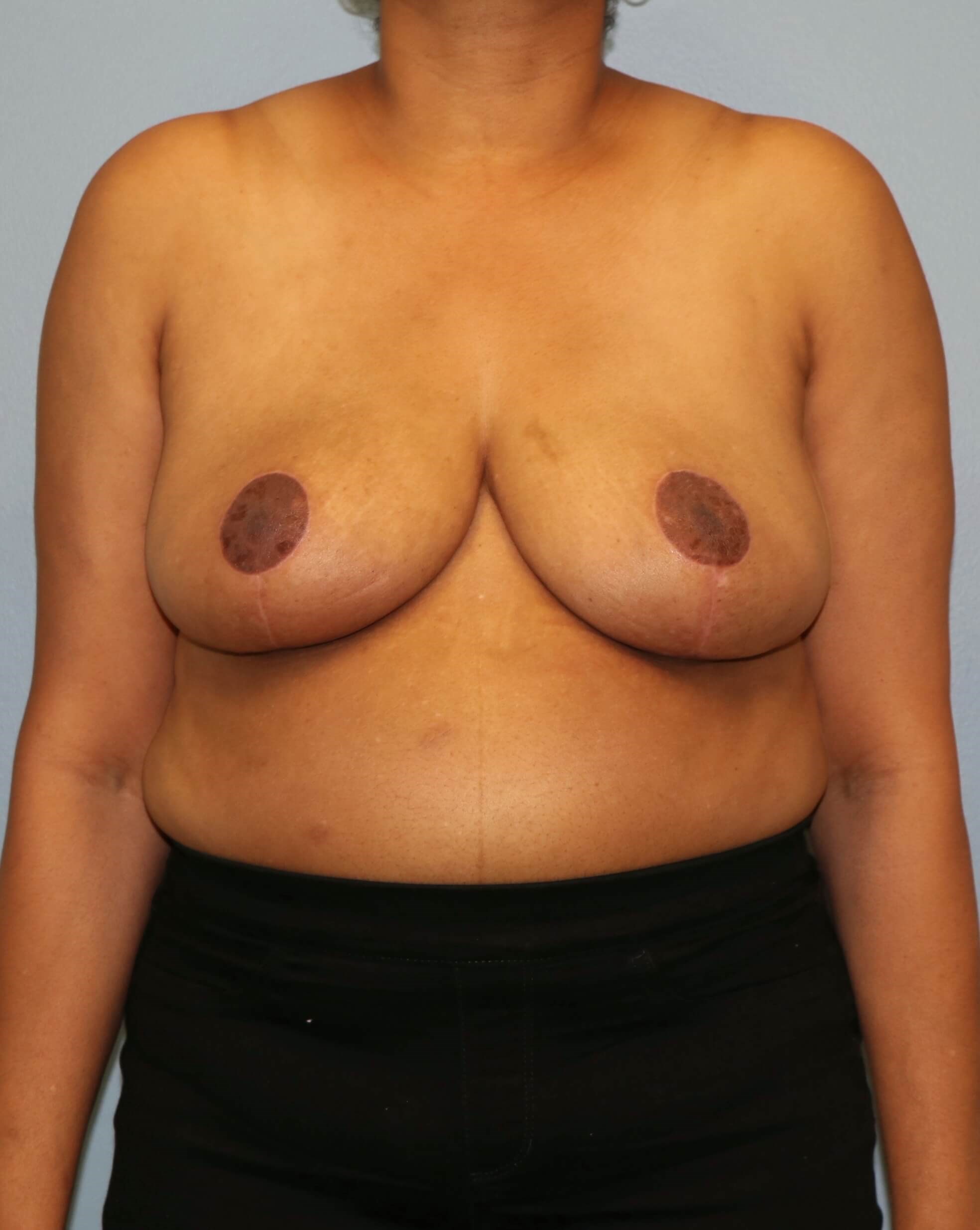 Breast Reduction Before/After After Breast Reduction