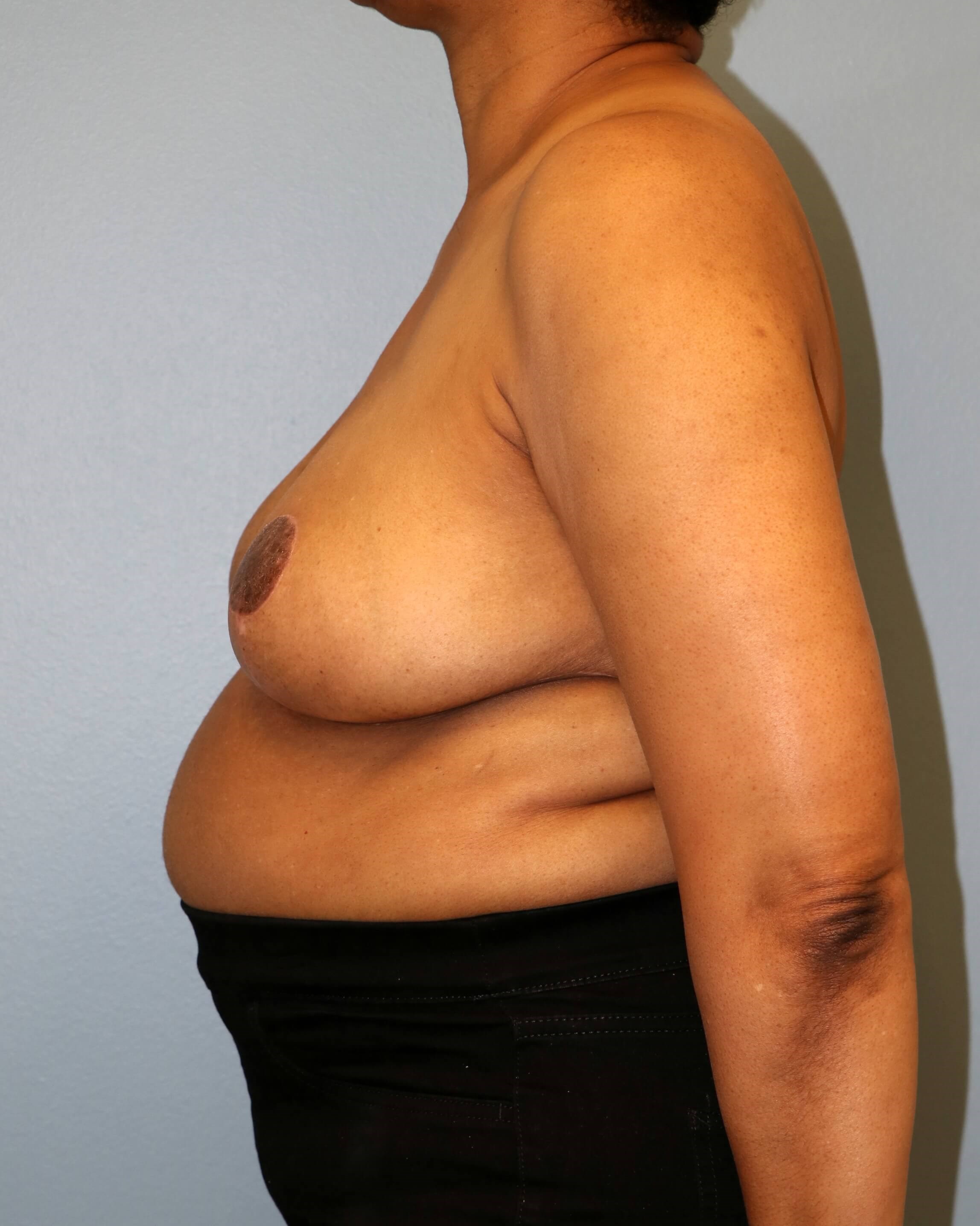 Breast Reduction Before/After After Breast Reduction