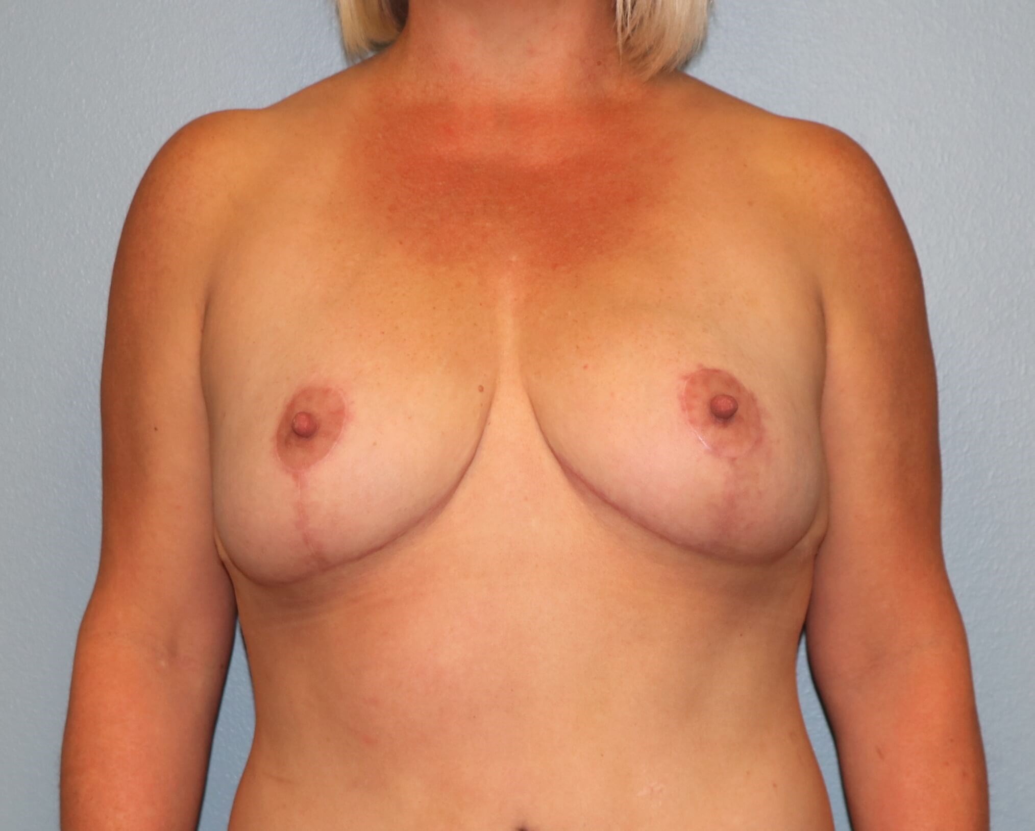 Breast Reduction & Liposuction After Breast Reduction