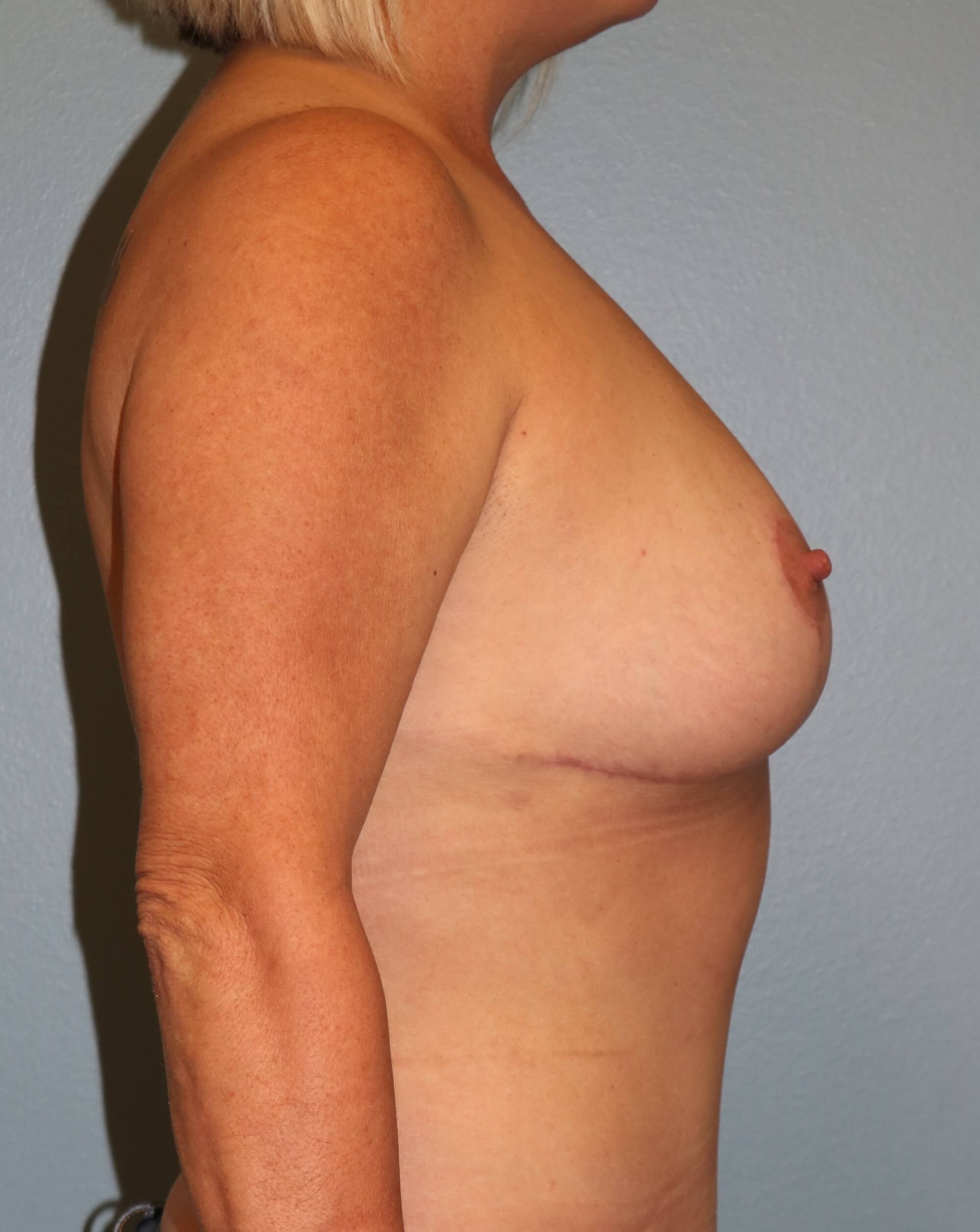 Breast Reduction & Liposuction After Breast Reduction