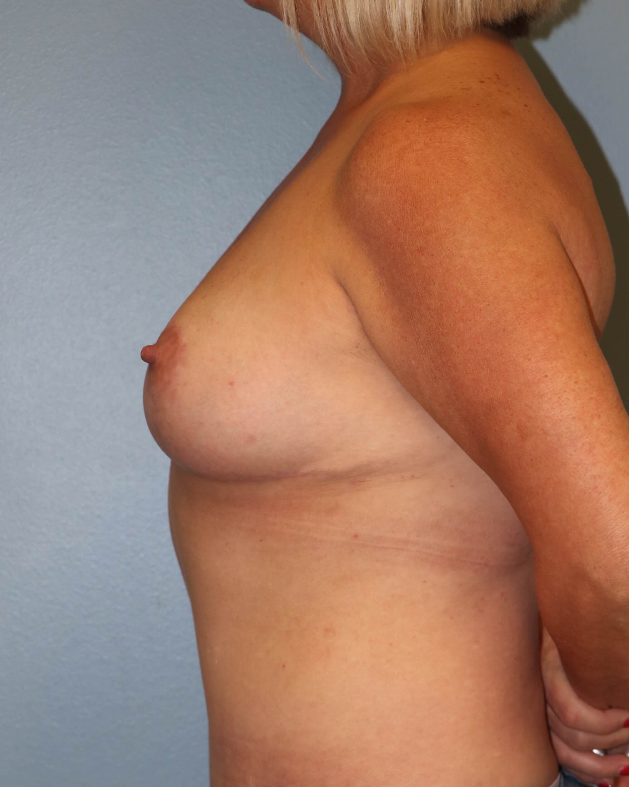 Breast Reduction & Liposuction After Breast Reduction