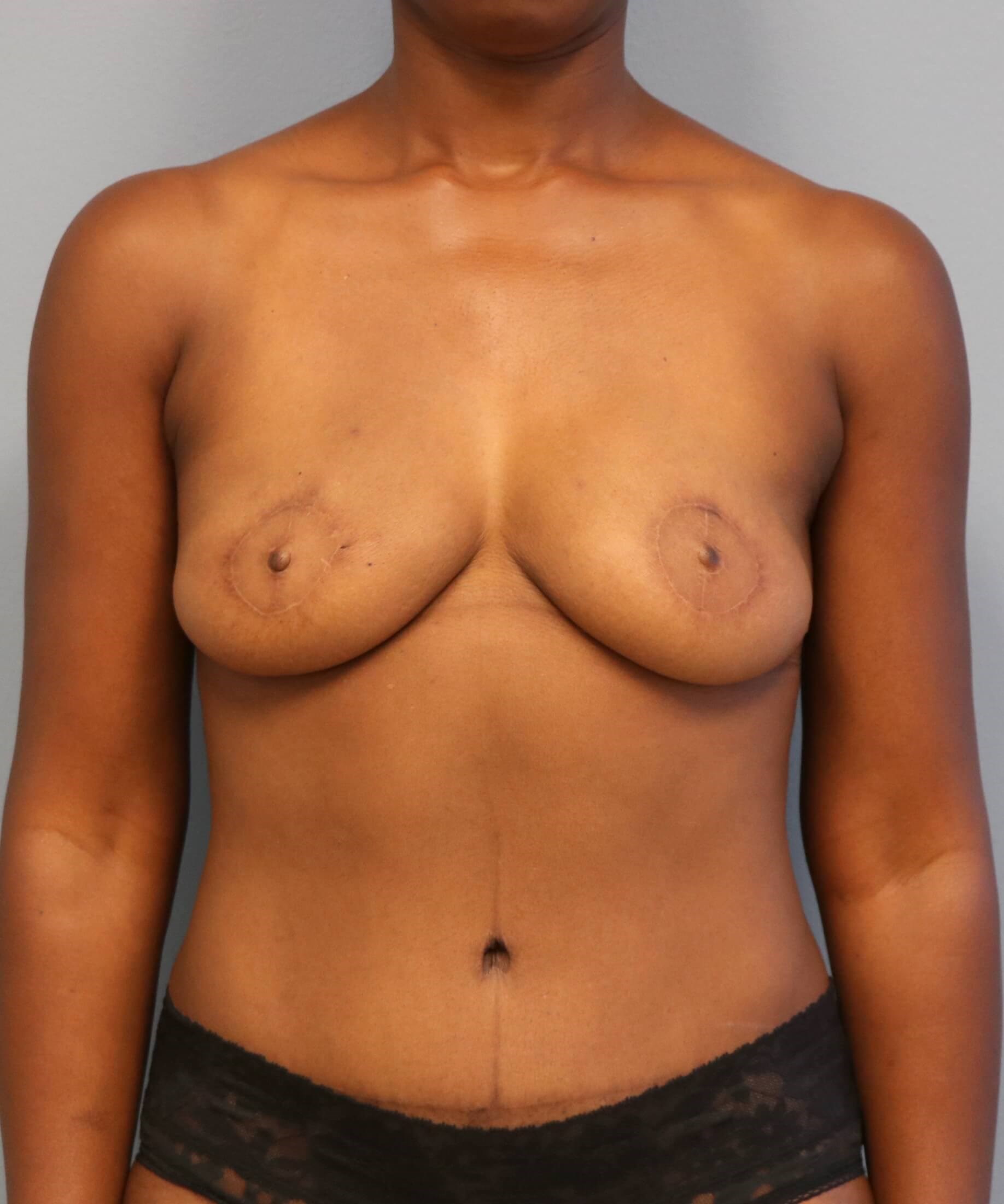 DIEP Flap Reconstruction After Bilateral DIEP Flaps