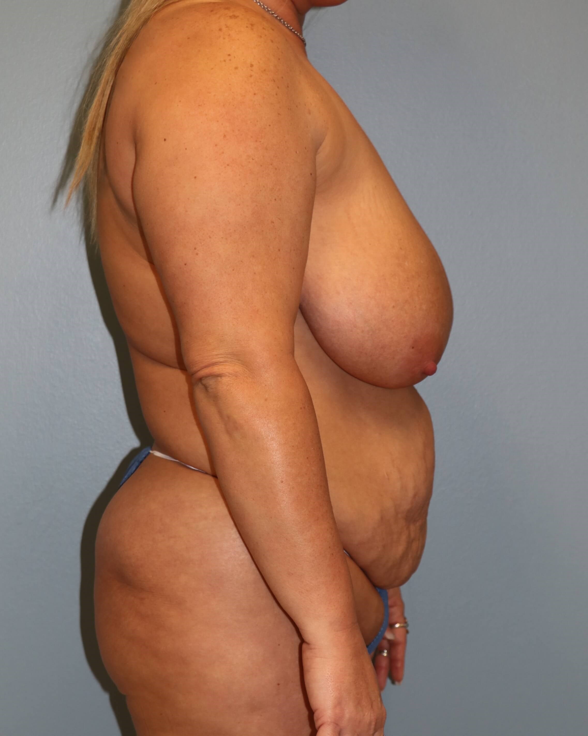 Mommy Makeover Before & After Before Mommy Makeover