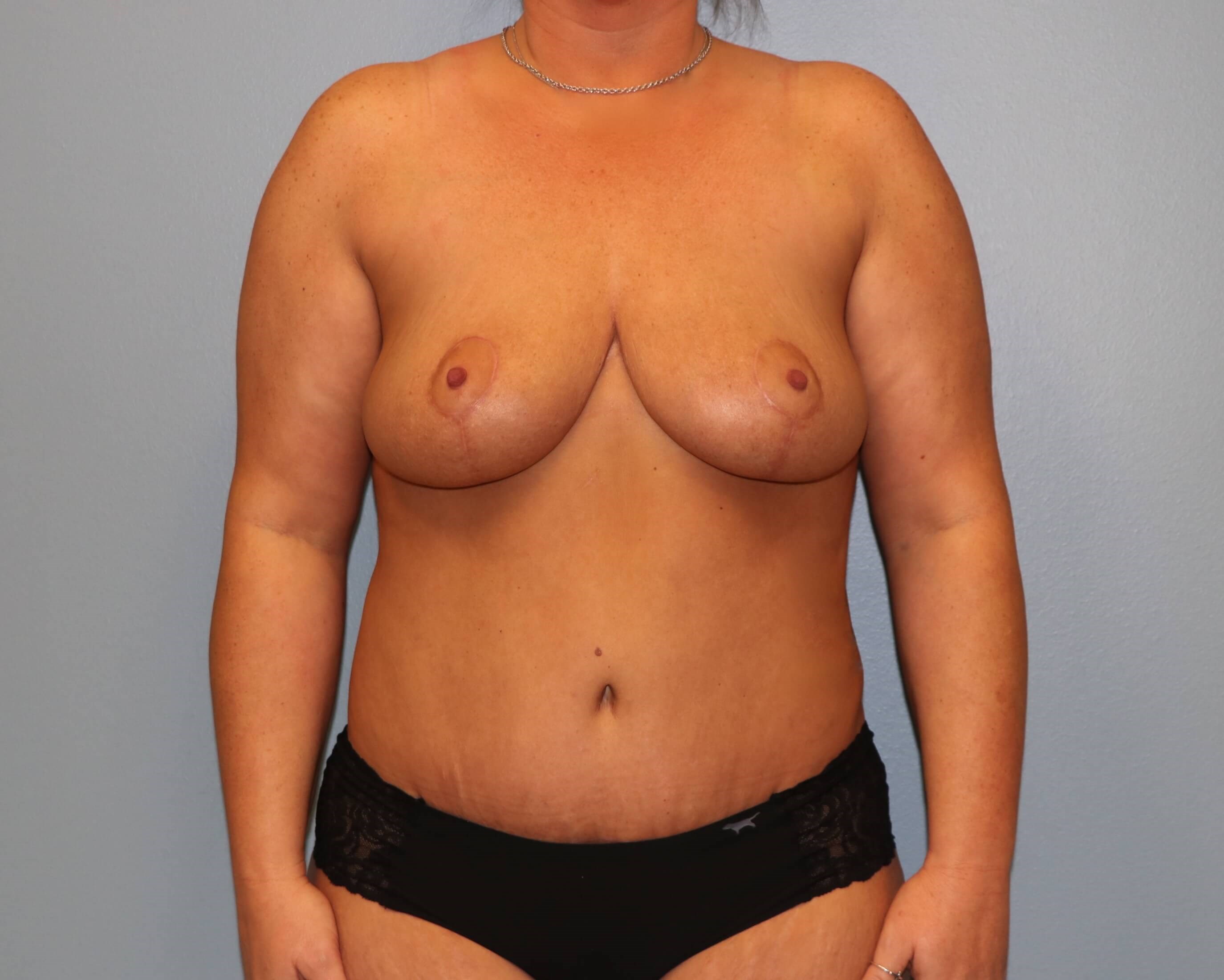 Mommy Makeover Before & After After Mommy Makeover