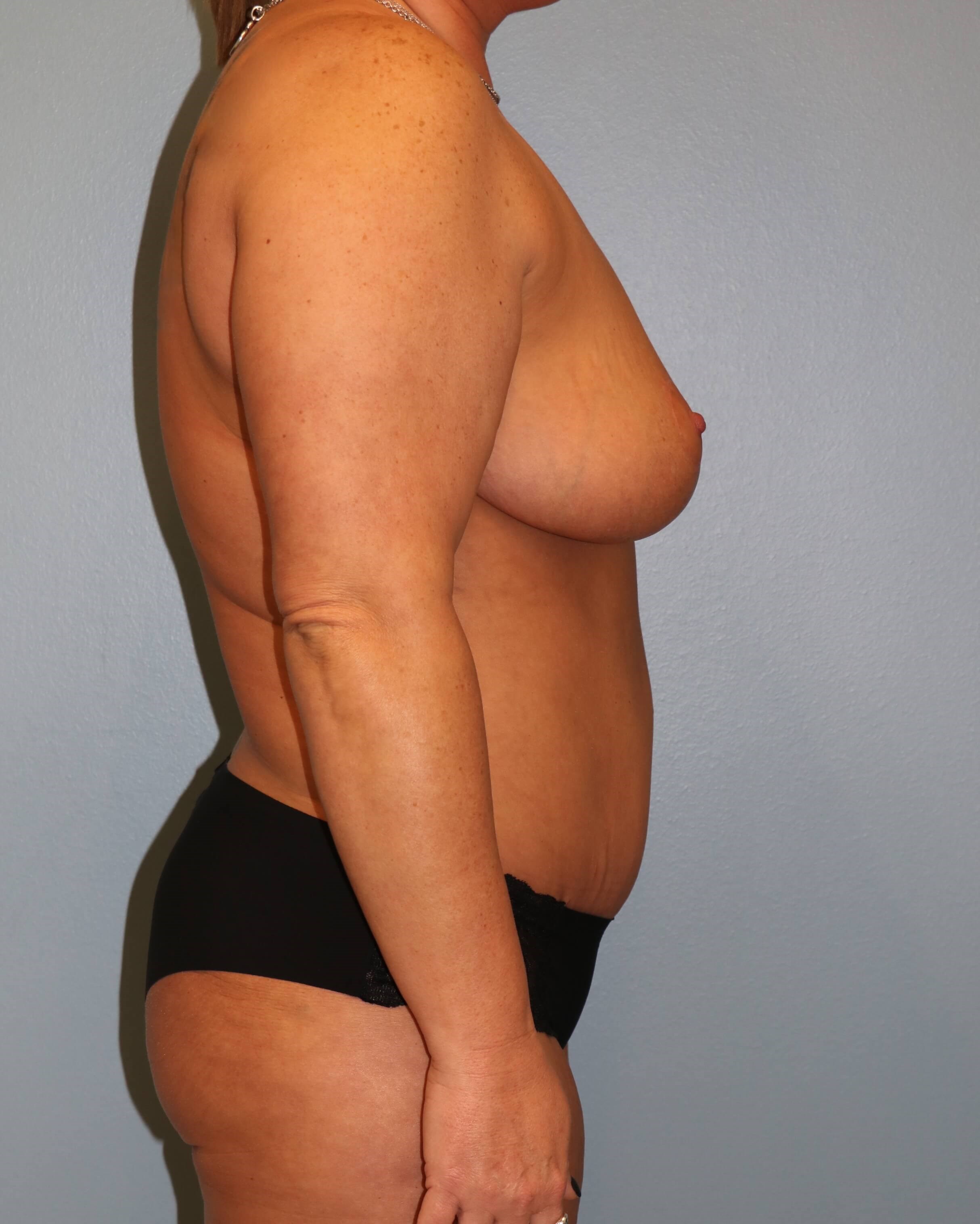Mommy Makeover Before & After After Mommy Makeover