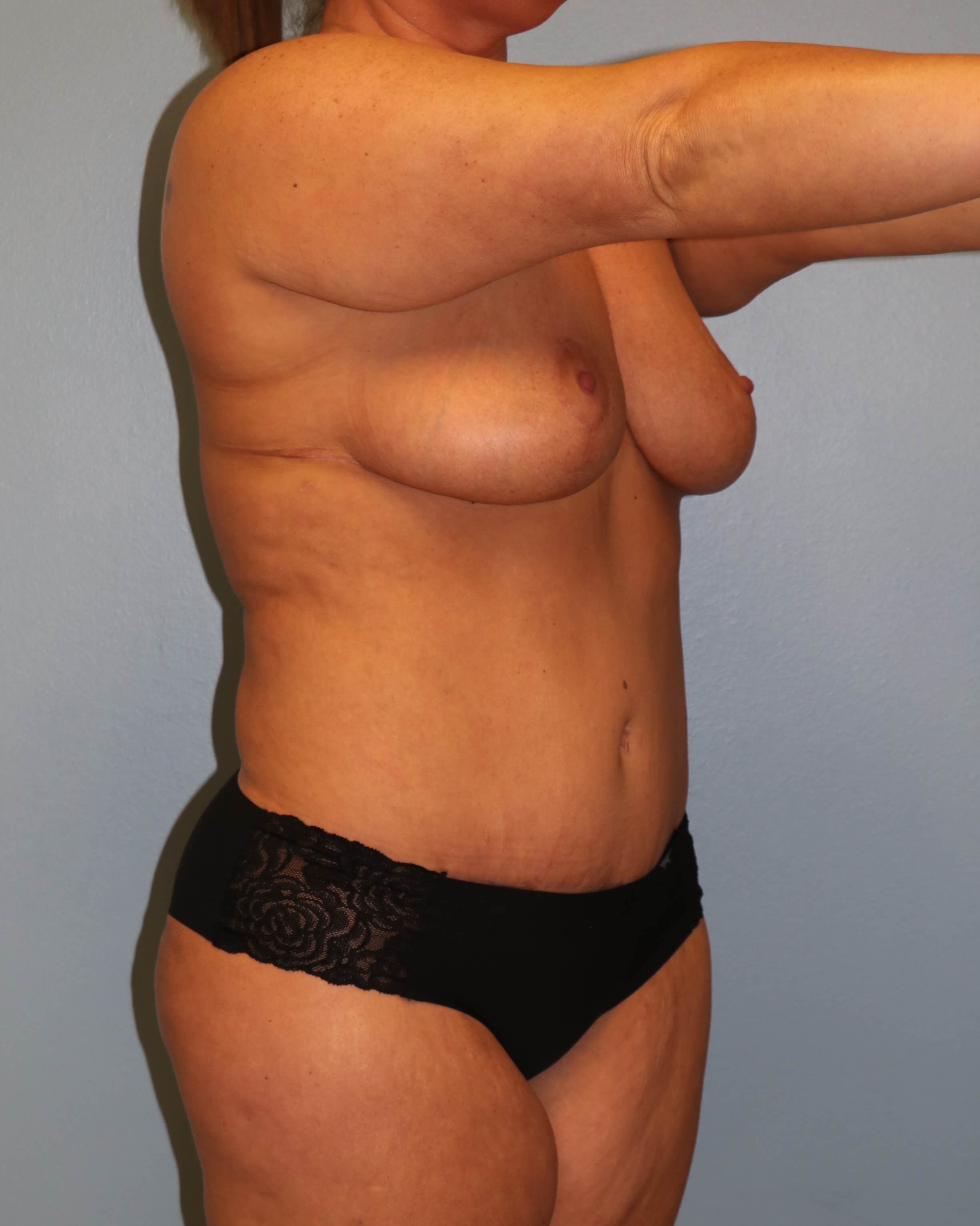 Mommy Makeover Before & After After Mommy Makeover